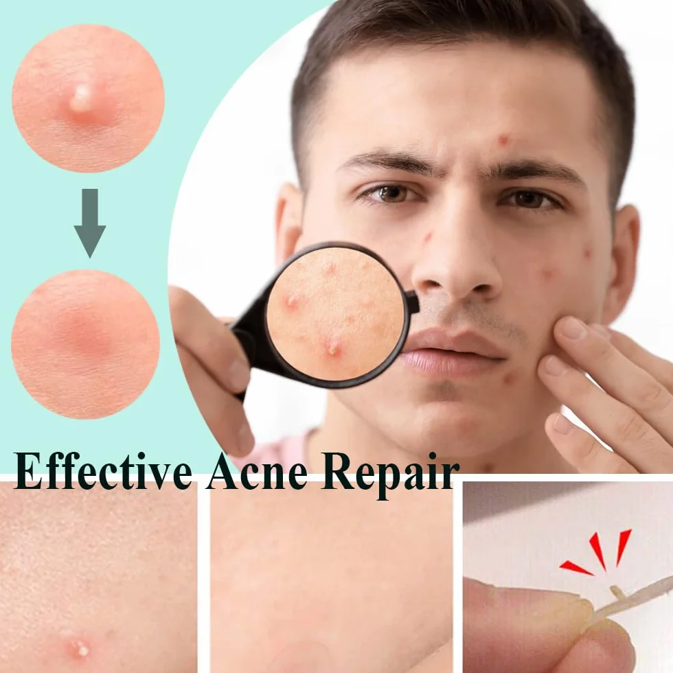 300 Pezzi Cerotti Brufoli Pimple Patch Brufoli Invisibili Idrocolloide Acne Pimple 2-In-1 Cerotti Per Brufoli con Olio Dell'Albero Del Tè Giorno e Notte Impermeabili e Traspiranti Patch Brufoli