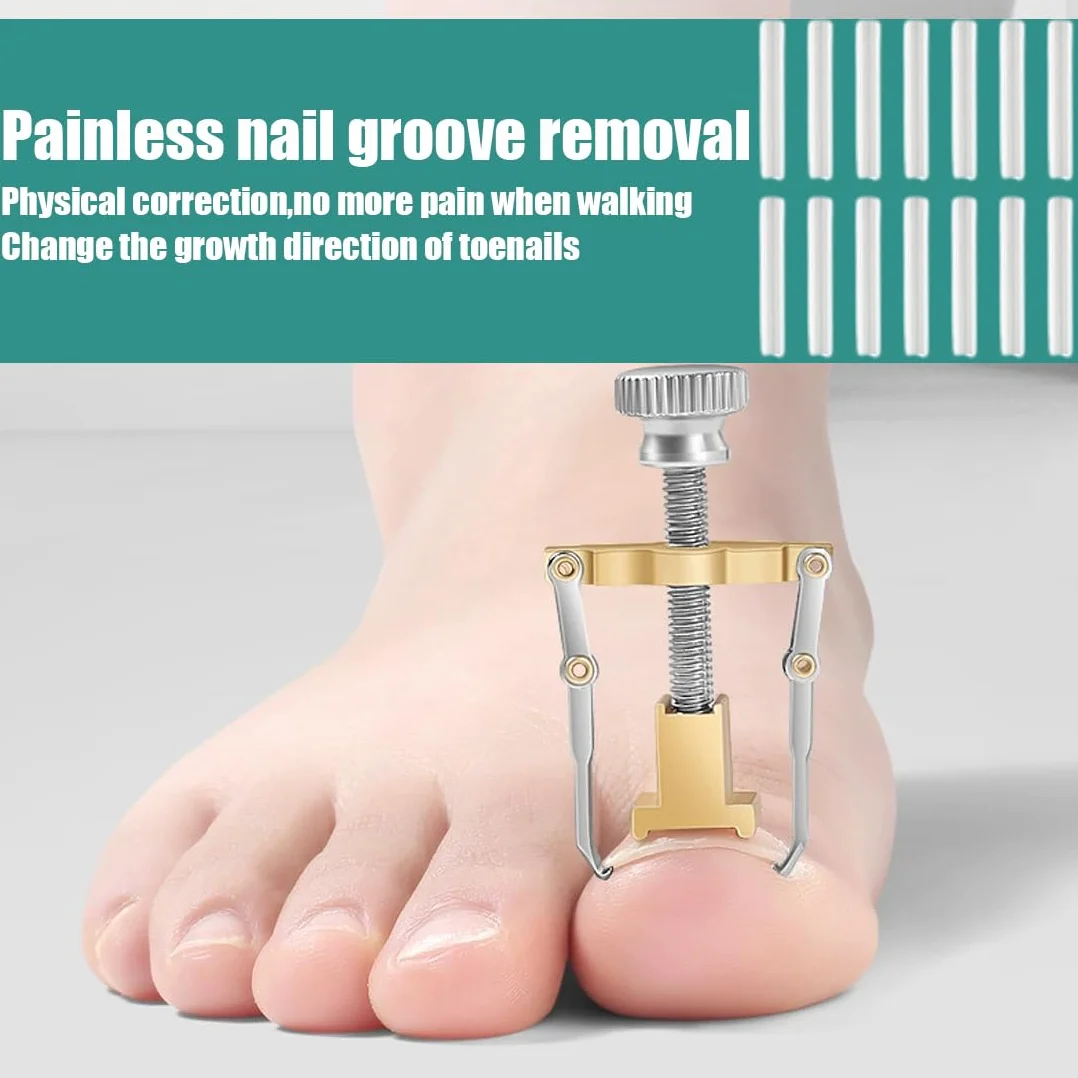 Correttore per Unghie Incarnite, Strisce Raddrizzanti senza Dolore con Ortesi e Solvente, 60 Pcs Set