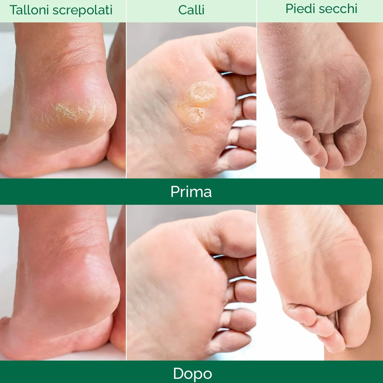 PLANTIFIQUE Maschera Piedi Esfoliante Trattamento Calli Duroni Scrub Piedi Peeling Forte 2 Paia