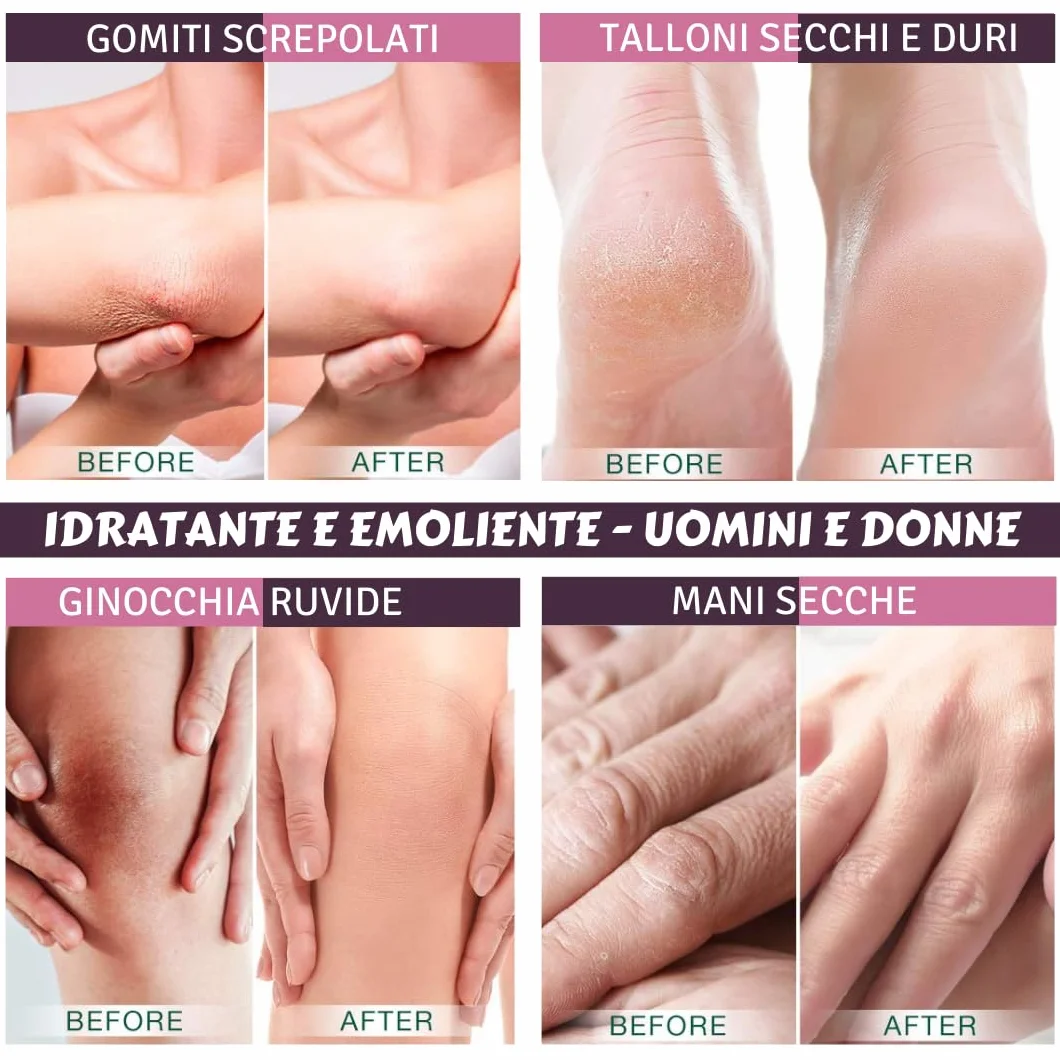 Urea 20% Crema Cheratolitica 100ml – Pelle sogetta a Psoriasi, Dermatite Atopica, Cheratosi, Ipercheratosi - Pelle Molto Secca, Desquamata e Fissurata, Prurito, Irritazioni Superficiali