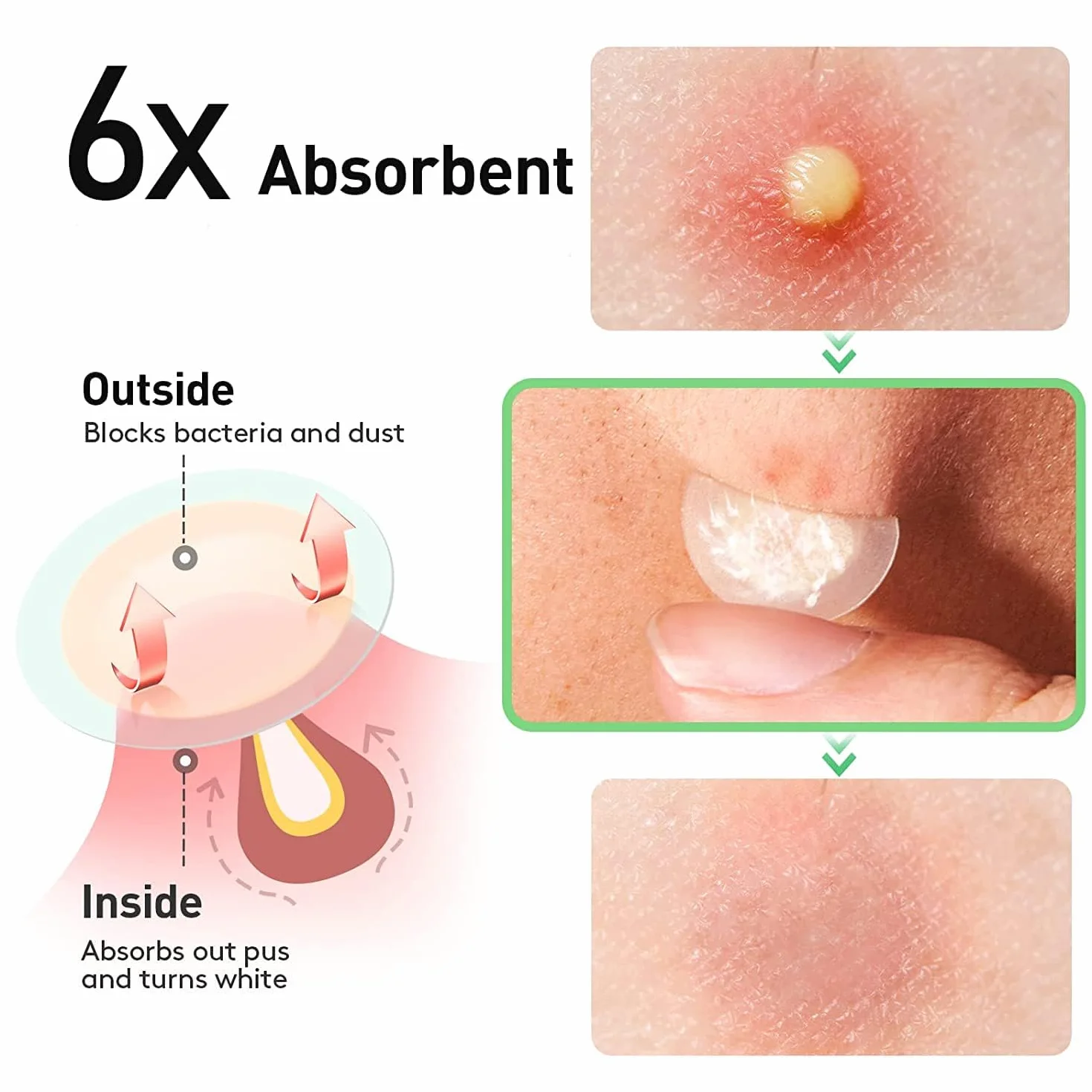 300 Pezzi Patch Brufoli Cerotti Pimple Patch Acne Invisibili Idrocolloide Cerotti Per Brufoli 2-In-1 Giorno e Notte Impermeabili e Traspiranti Pimple Patches