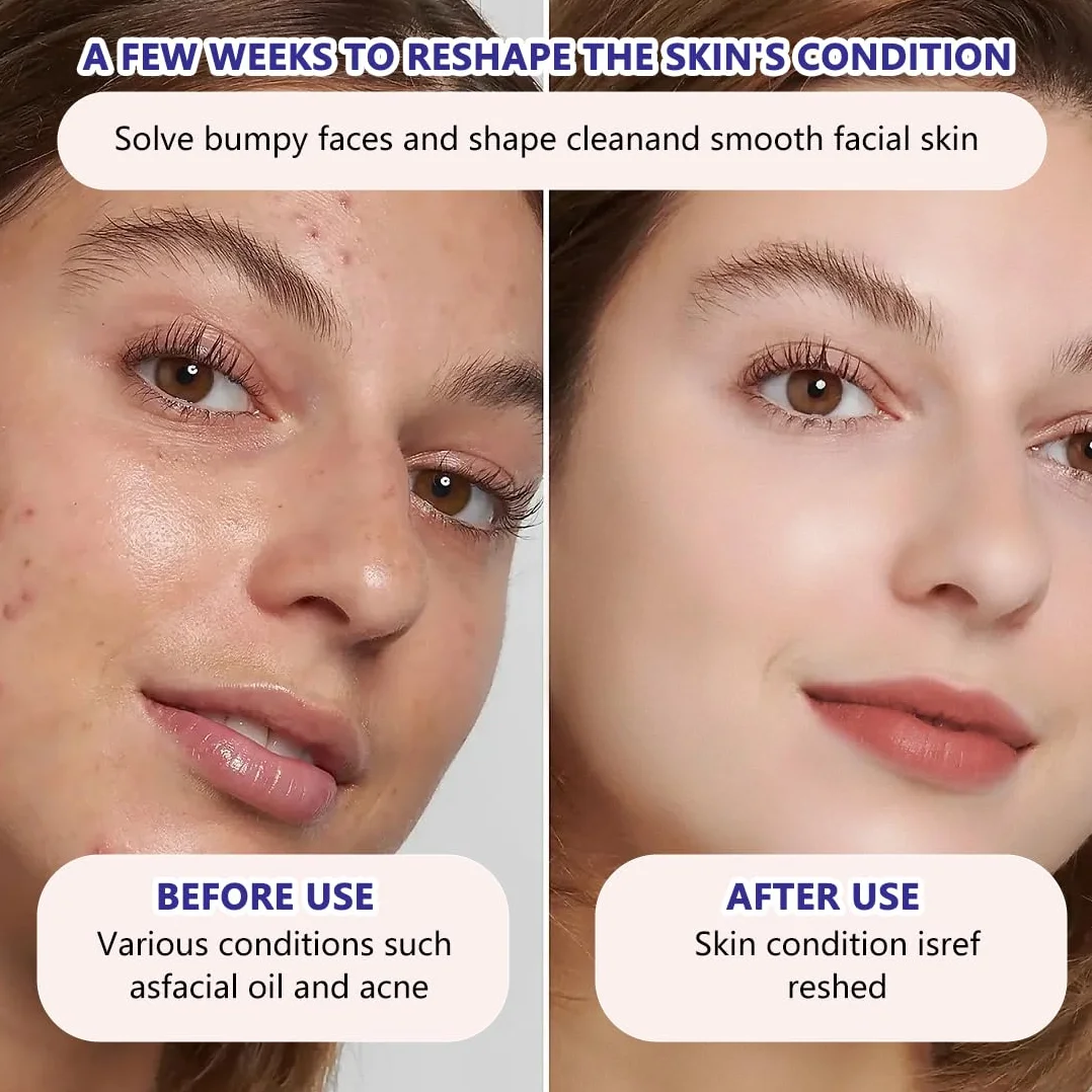 Schiuma Detergente per Pelle Impura：Detersione profonda per rimuovere trucco e impurità. Aiuta a liberare i pori e a purificare la pelle.