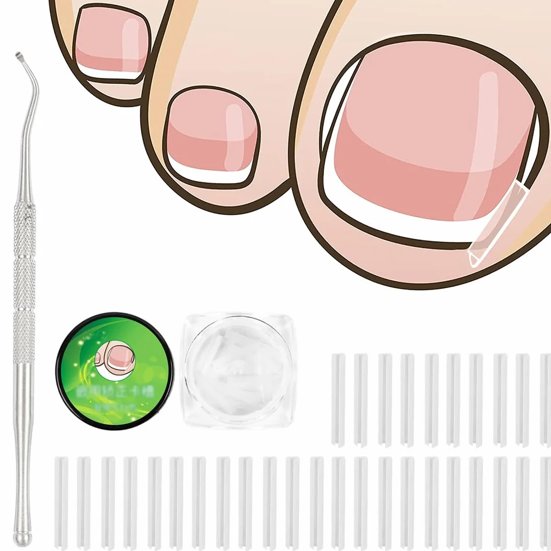 Set correttore per unghie incarnite 50 pezzi, Strisce raddrizzanti senza dolore con sollevatore, Kit strumenti