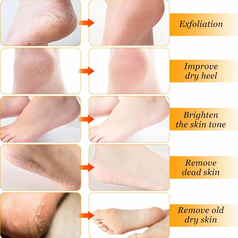Spray per la Rimozione del Callo del Piede, Spray per il Peeling del Piede, Spray per Rimuovere i Calli dei Piedi,per Talloni Ruvidi e Screpolati, Pelle Secca e Calli