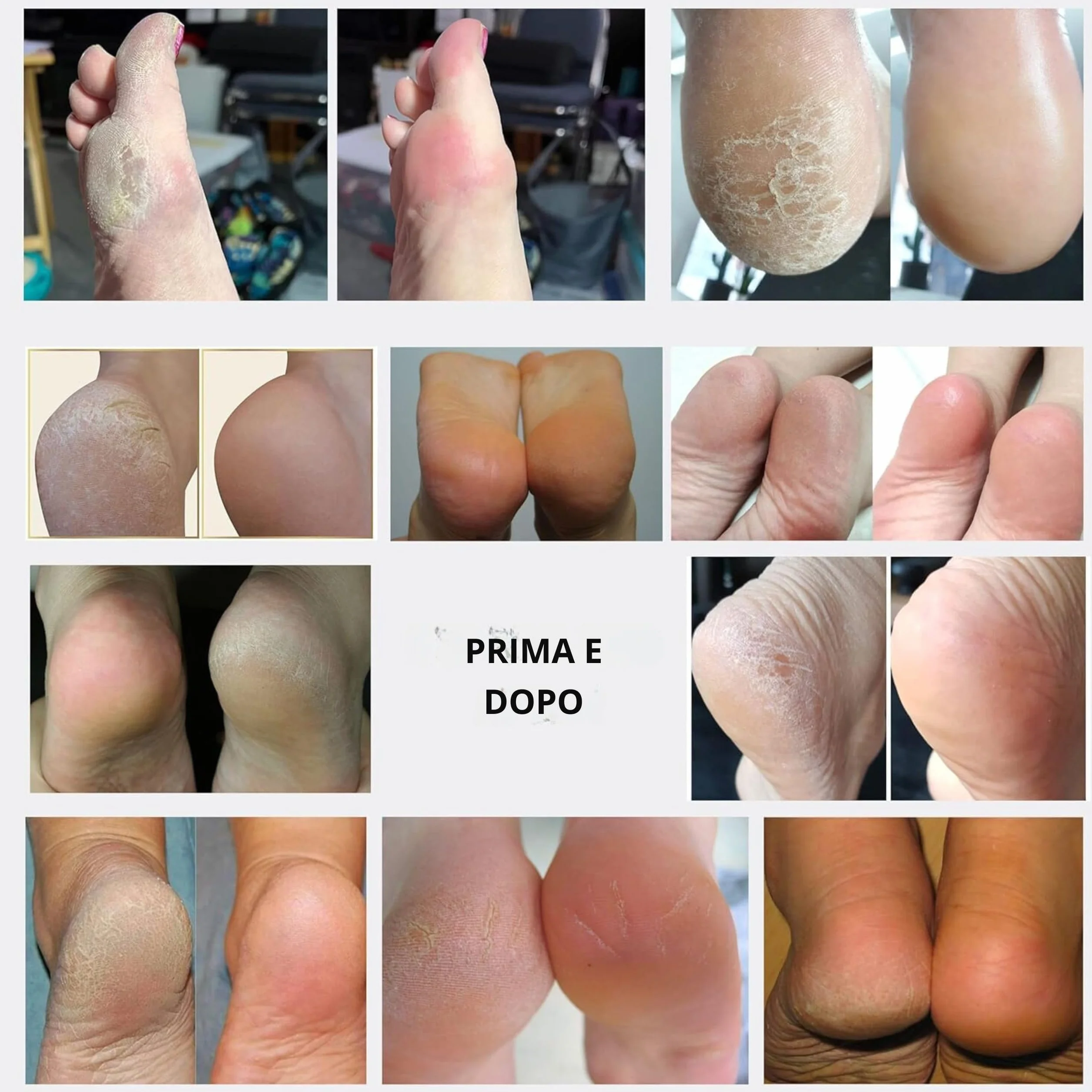 Spray esfoliante istantaneo per rimuovere i calli, rimuove la pelle morta e talloni screpolati, trattamento pedicure per la casa, funziona con qualsiasi lima o scrubber per piedi. Wonder Pedi