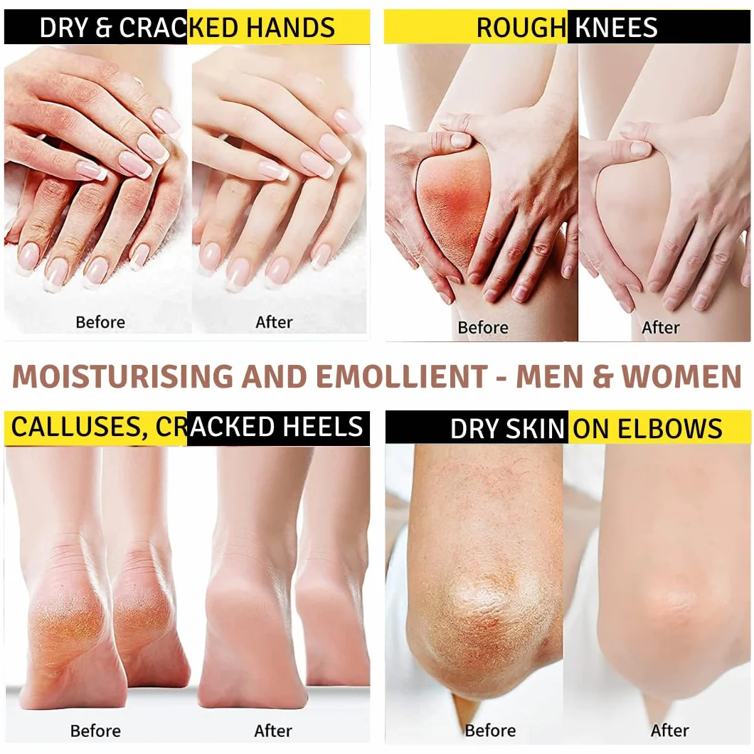 Crema Urea 20%, Eczemi, Cheratosi, Psoriasi, Eruzioni Cutanee, Riduce il Prurito, Sechezza, Pelle Secca e Screpolata, Calli, Duroni, Desquamazioni,- Cocos e Olio d'Oliva, 50g