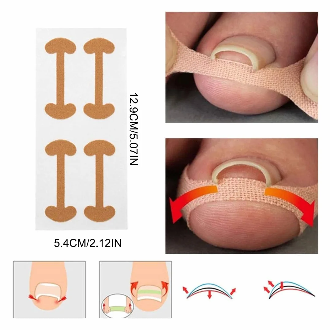 Cerotti per Unghie Incarnite, Strumenti per Pedicure, Foglio Correttore, 50 Pezzi