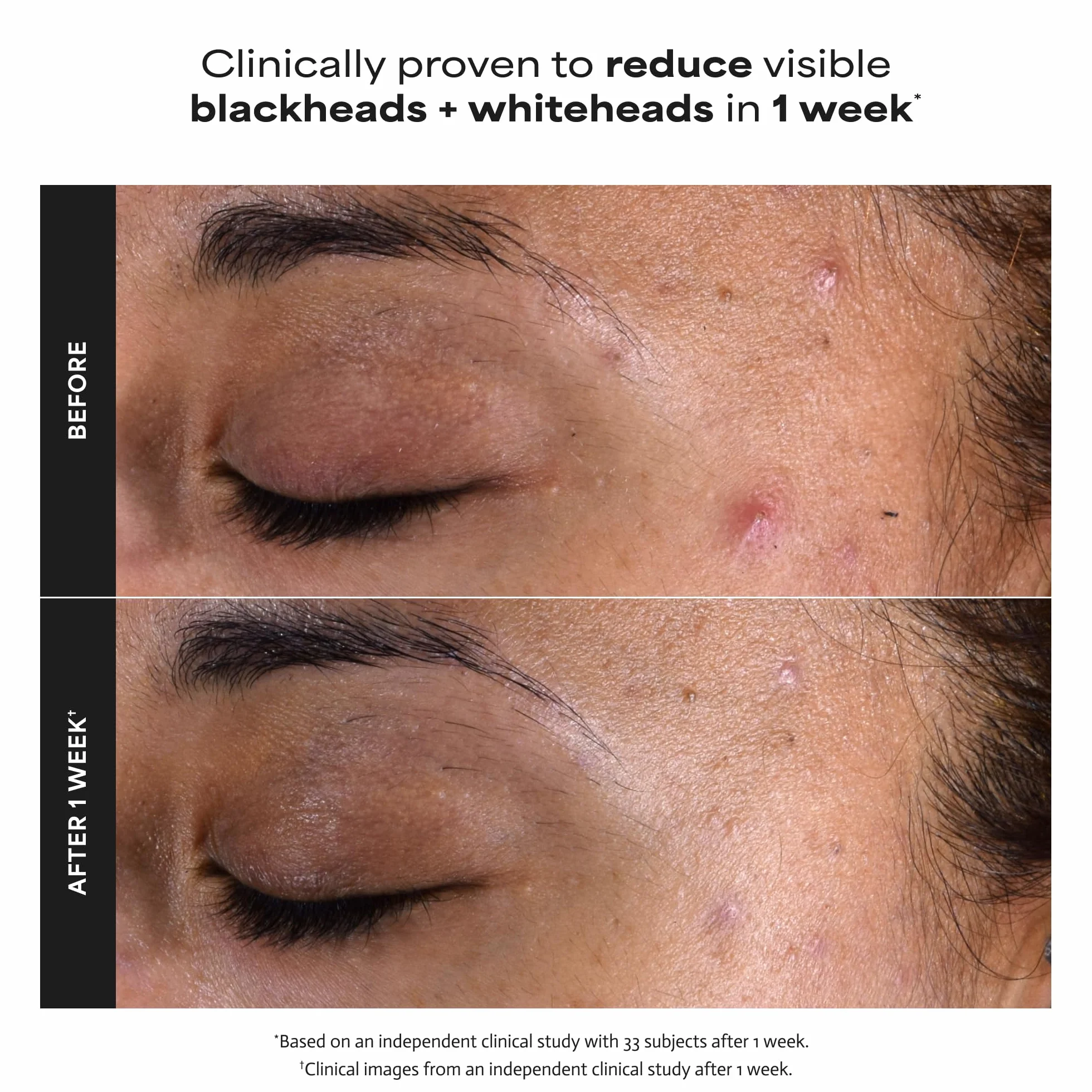 Paula's Choice SKIN PERFECTING 2% BHA Esfoliante Liquido - Peeling Viso con Acido Salicilico - Combatte Imperfezioni, Punti Neri & Brufoli - Ridurre i Pori - Pelli Miste o Grasse - 30 ml