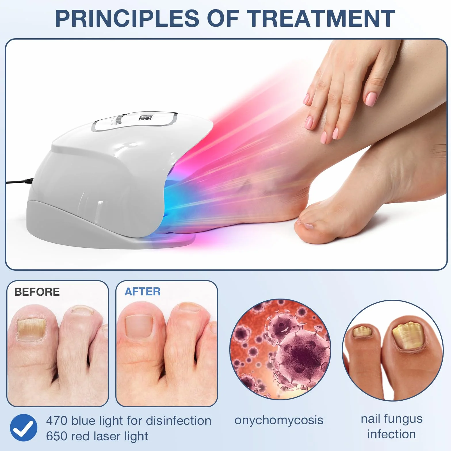 iKeener Dispositivo laser per funghi del chiodo, approvato dalla FDA, pulizia delle unghie e onicomicosi, rimozione funghi con luce blu 15 x 470 nm + 30 x 650 nm luce rossa, sessioni