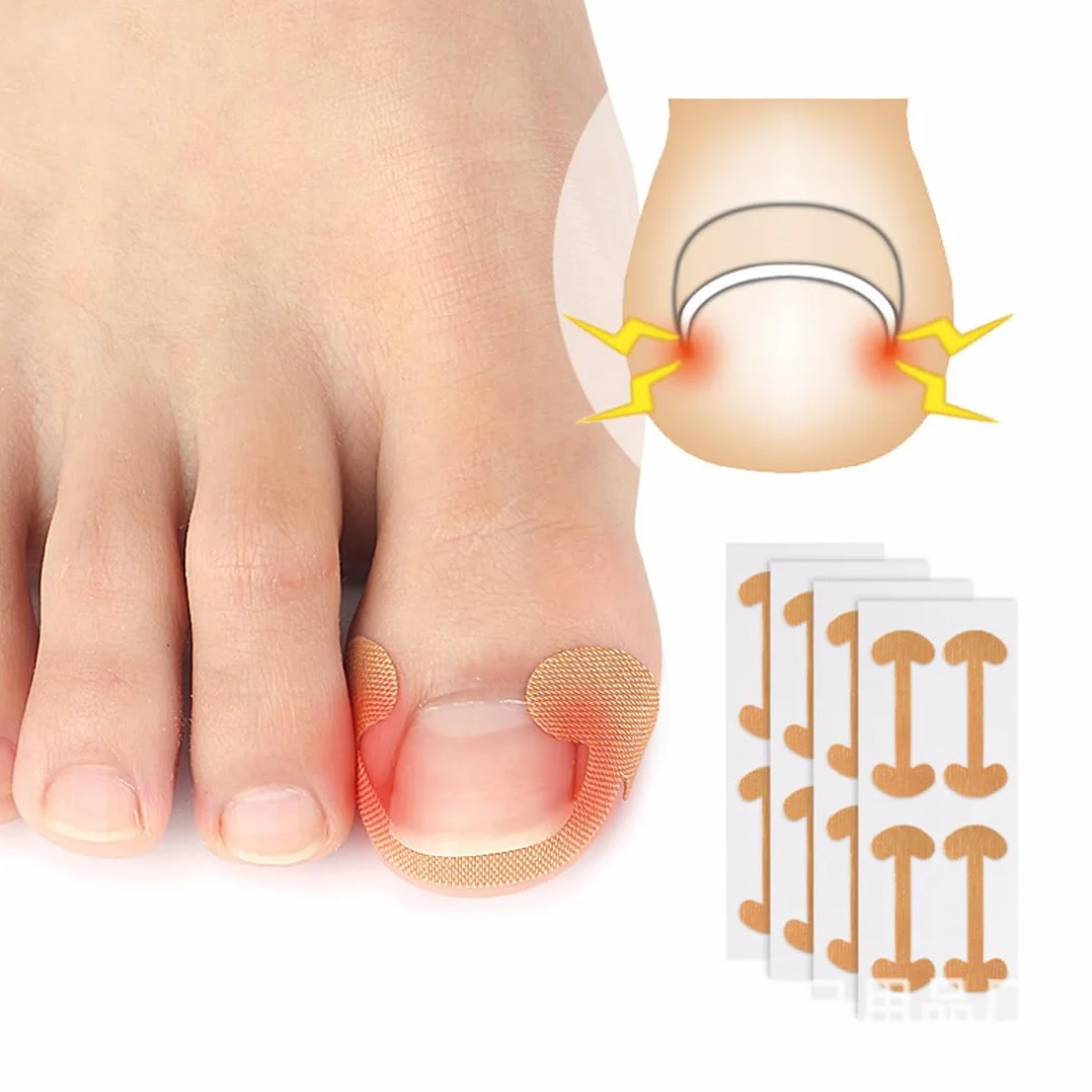 Cerotti per Unghie Incarnite, Strumenti per Pedicure, Foglio Correttore, 50 Pezzi
