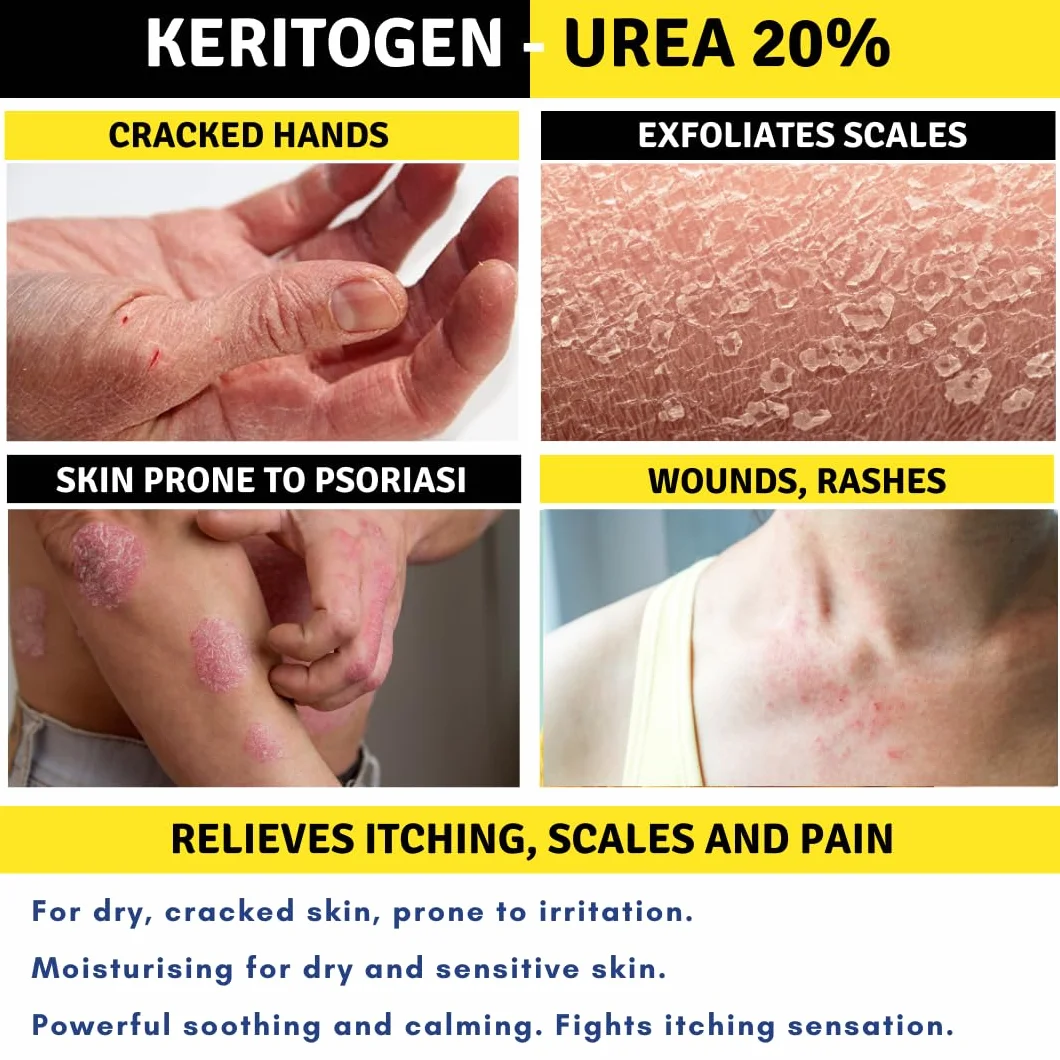 Crema Urea 20%, Eczemi, Cheratosi, Psoriasi, Eruzioni Cutanee, Riduce il Prurito, Sechezza, Pelle Secca e Screpolata, Calli, Duroni, Desquamazioni,- Cocos e Olio d'Oliva, 50g