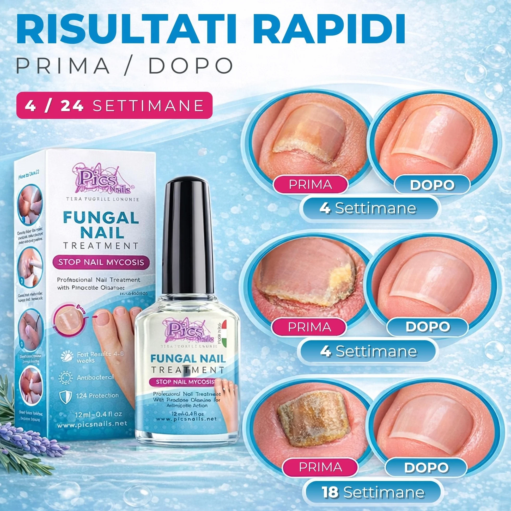 Antimicotico Micosi Unghie Piedi e Mani 12 ml - Trattamento Micosi del Piede e della Mano