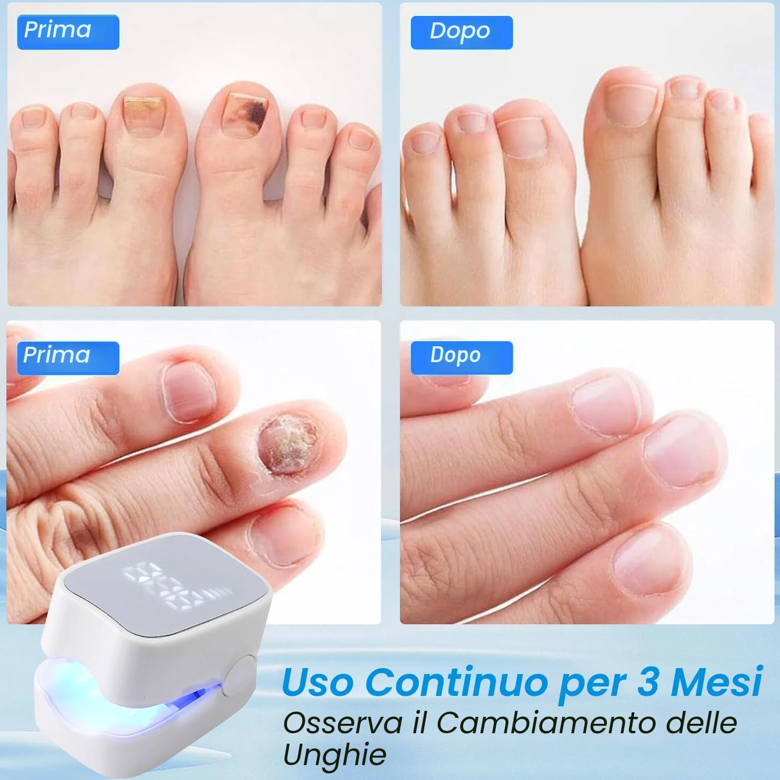 Mycose delle Unghie Laser, Mycose delle Unghie dei Piedi Pulizia e Riparazione Unghie, Dispositivo Trattamento Laser per Micosi delle Unghie dei Piedi, 7 Min al Giorno per Migliorare la Micosi Fungosa
