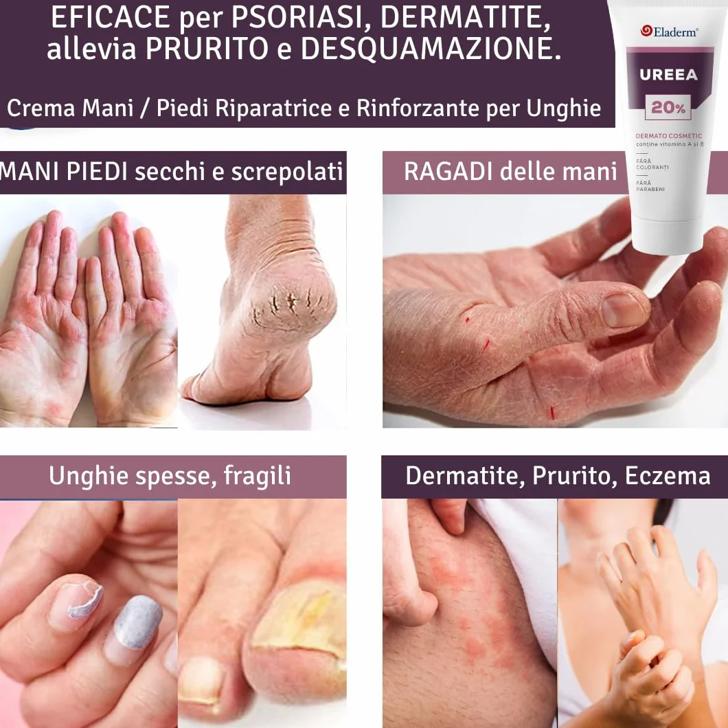 Urea 20% Crema Cheratolitica 100ml – Pelle sogetta a Psoriasi, Dermatite Atopica, Cheratosi, Ipercheratosi - Pelle Molto Secca, Desquamata e Fissurata, Prurito, Irritazioni Superficiali