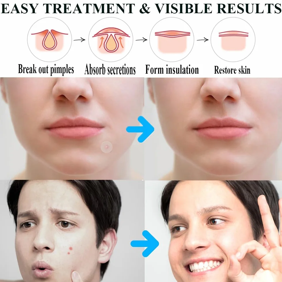 300 Pezzi Cerotti Brufoli Pimple Patch Brufoli Invisibili Idrocolloide Acne Pimple 2-In-1 Cerotti Per Brufoli con Olio Dell'Albero Del Tè Giorno e Notte Impermeabili e Traspiranti Patch Brufoli