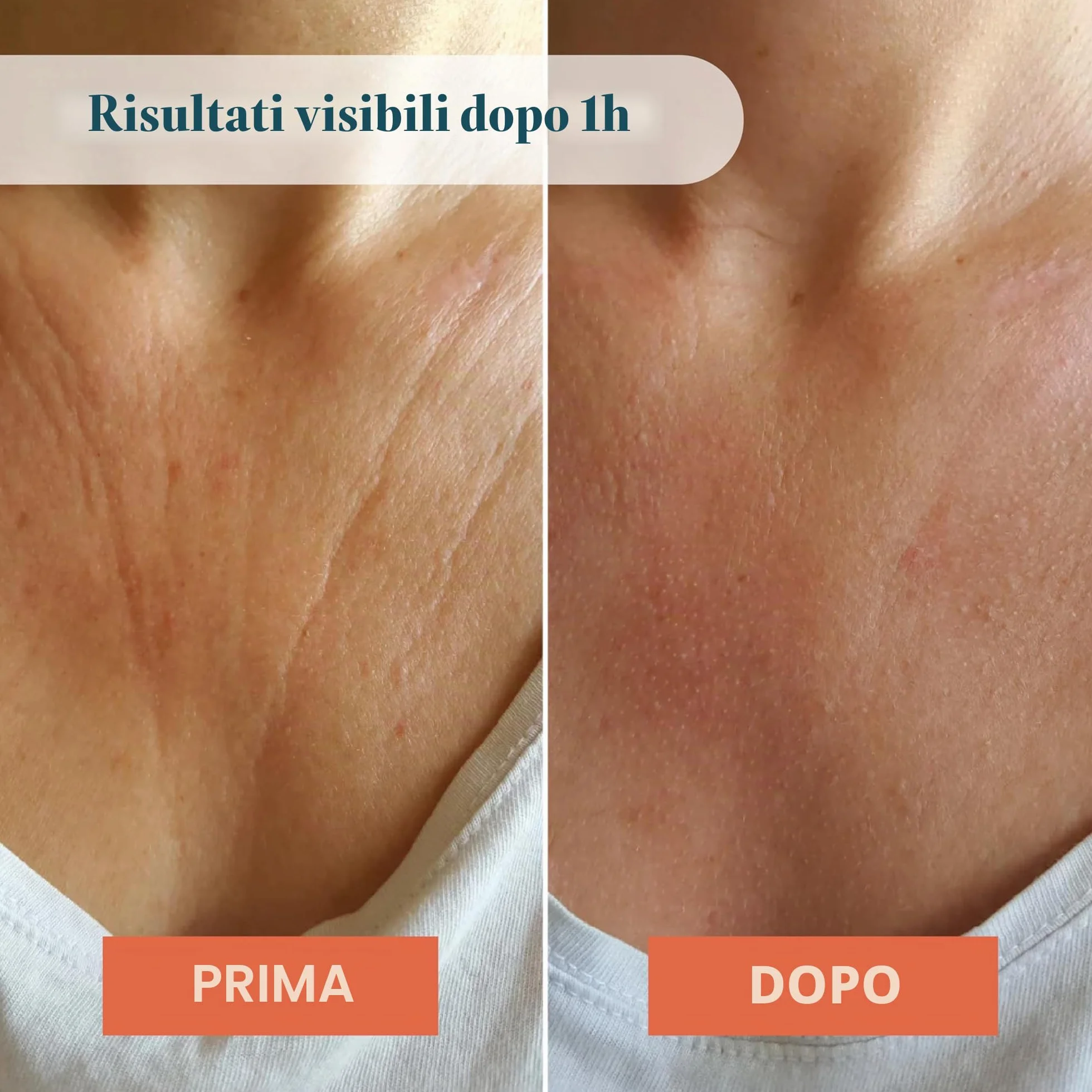APRICOT decollete Pad antirughe in silicone medico con acido ialuronico a basso peso molecolare – Riutilizzabile fino a 30 volte, dermatologicamente confermato, vegano e senza sperimentazione su