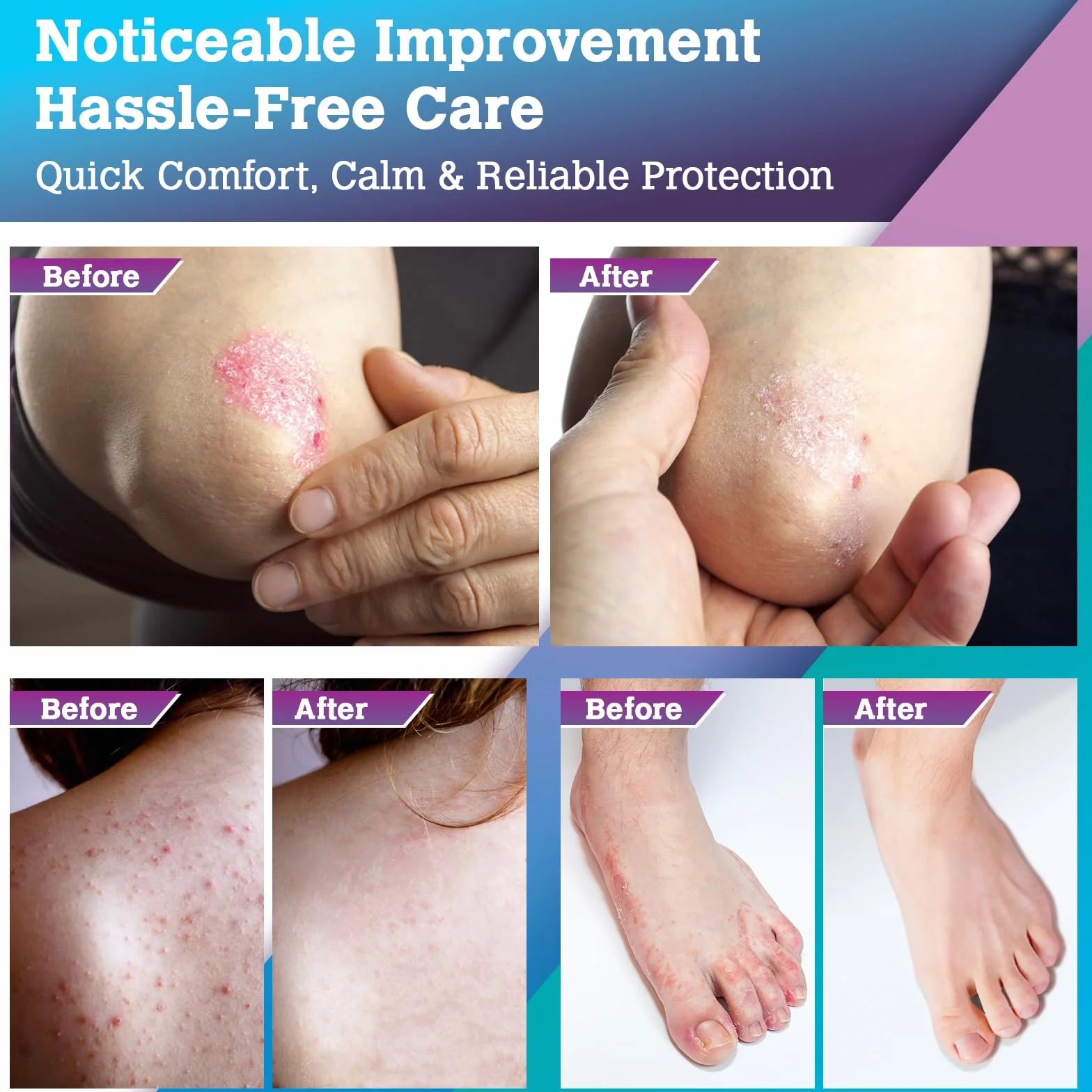Crema Antimicotica Piedi Pelle Antiprurito: Trattamento Topico per Piedi, Inguine, Ascelle e Pieghe Cutanee