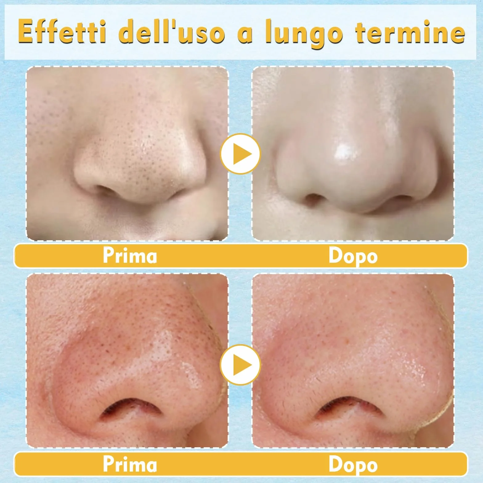 20 Cerotti Punti Neri Naso - Patch con Tecnologia Idrocolloide per la Rimozione di Punti Neri, Pori Puliti e Ridotti, Ideali per Tutti i Tipi di Pelle (20)