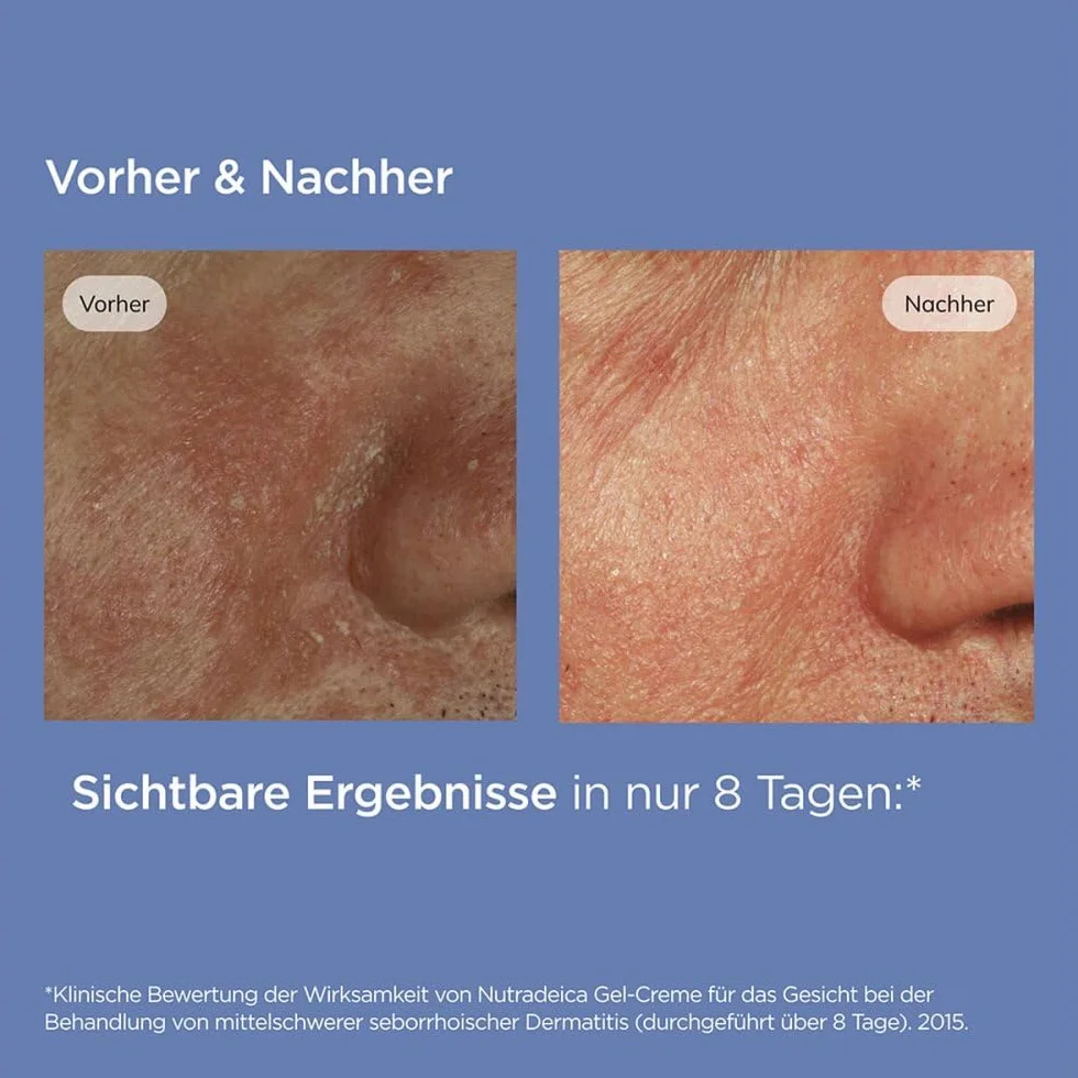 ISDIN Nutradeica Seborrheic Skin Gel Crema Viso (50 ml) | Idrata, Lenisce e Opacizza | Per Pelli a Tendenza Seborroica | Uso Quotidiano
