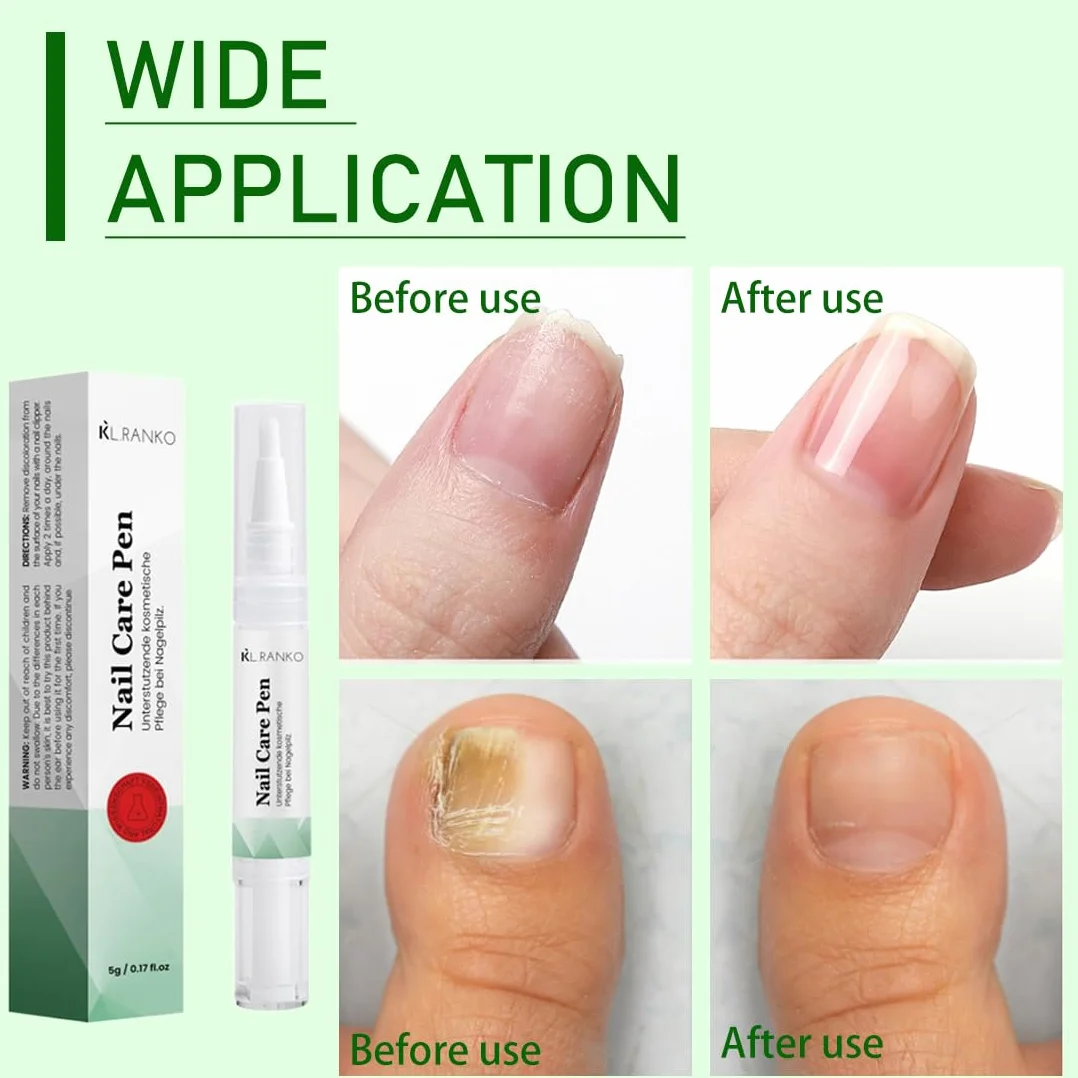 2 Pezzi Nail Care Pen, Penna per la Cura Delle Unghie