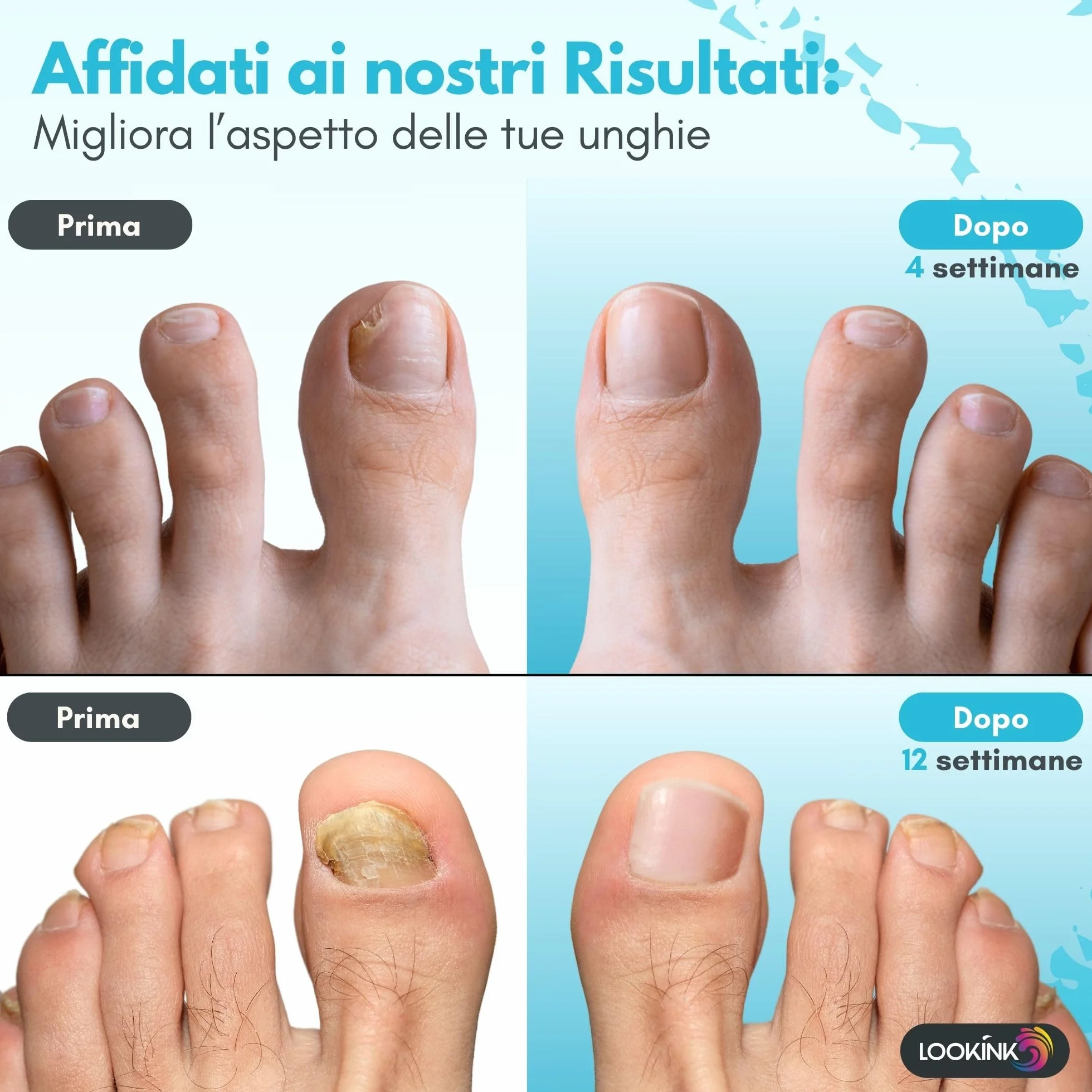Smalto per Micosi Unghie Piedi e Mani 12 ml - Made in Italy - Trattamento Antimicotico Forte Smalto ideale per Funghi e Onicomicosi - Trattamento Efficace Per la Ricrescita di Unghie Sane