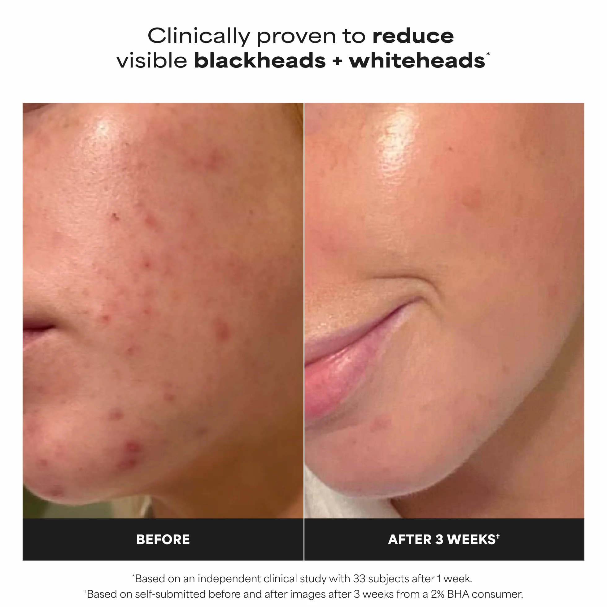 Paula's Choice SKIN PERFECTING 2% BHA Esfoliante Liquido - Peeling Viso con Acido Salicilico - Combatte Imperfezioni, Punti Neri & Brufoli - Ridurre i Pori - Pelli Miste o Grasse - 30 ml