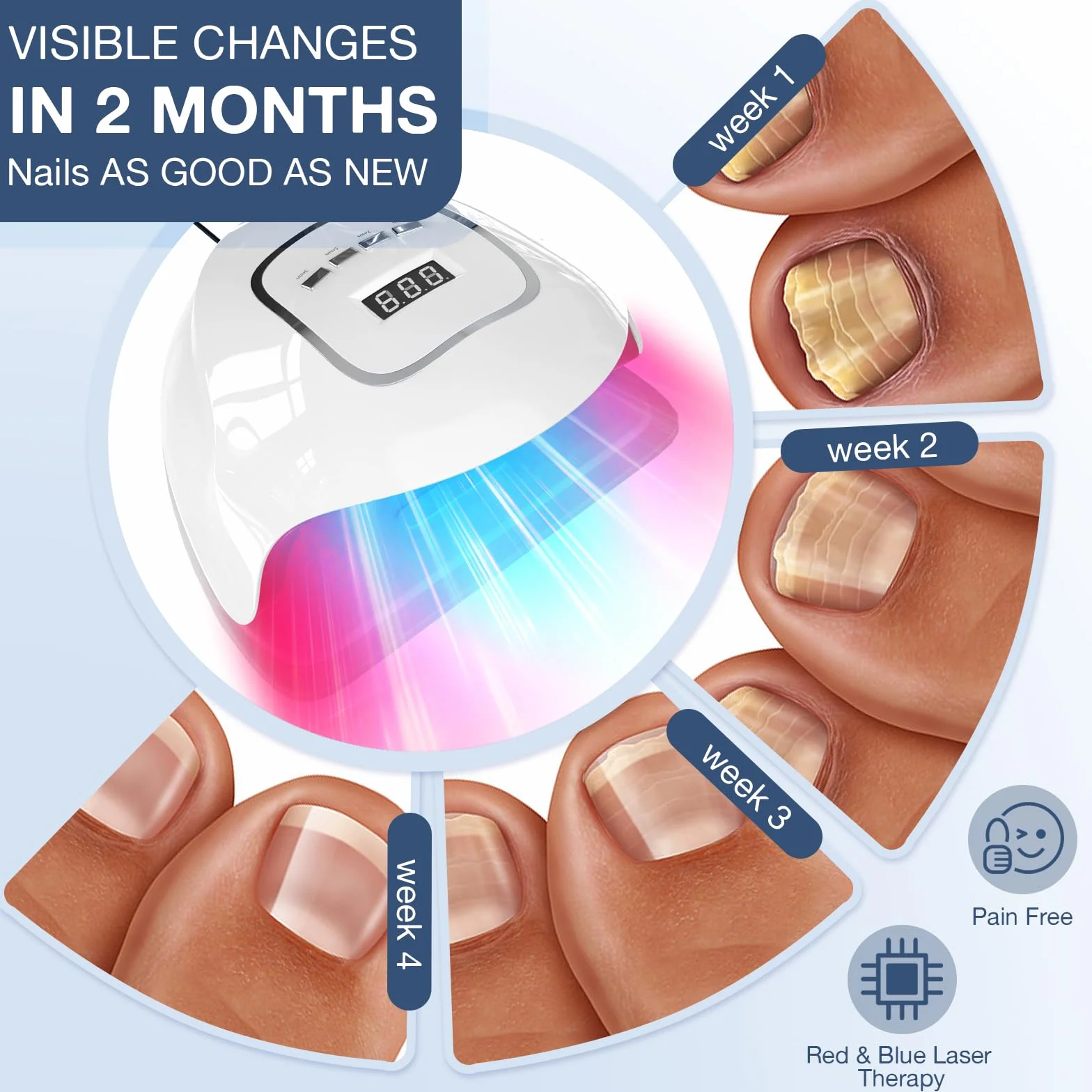 iKeener Dispositivo laser per funghi del chiodo, approvato dalla FDA, pulizia delle unghie e onicomicosi, rimozione funghi con luce blu 15 x 470 nm + 30 x 650 nm luce rossa, sessioni