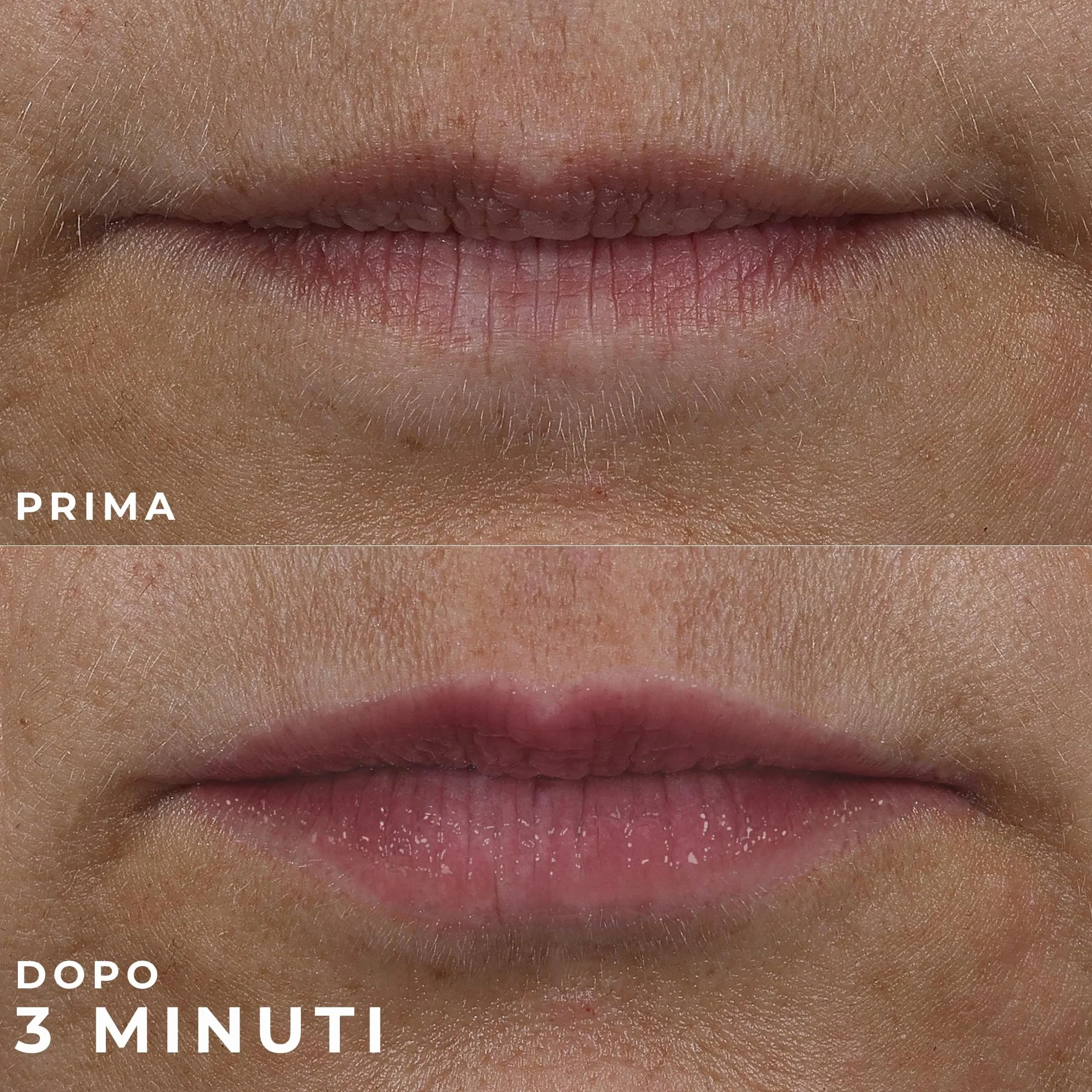 RoC Derm Correxion Volumizzante Labbra Balsamo Rimpolpante con Acido Ialuronico e Peptidi di Collagene 10 ml