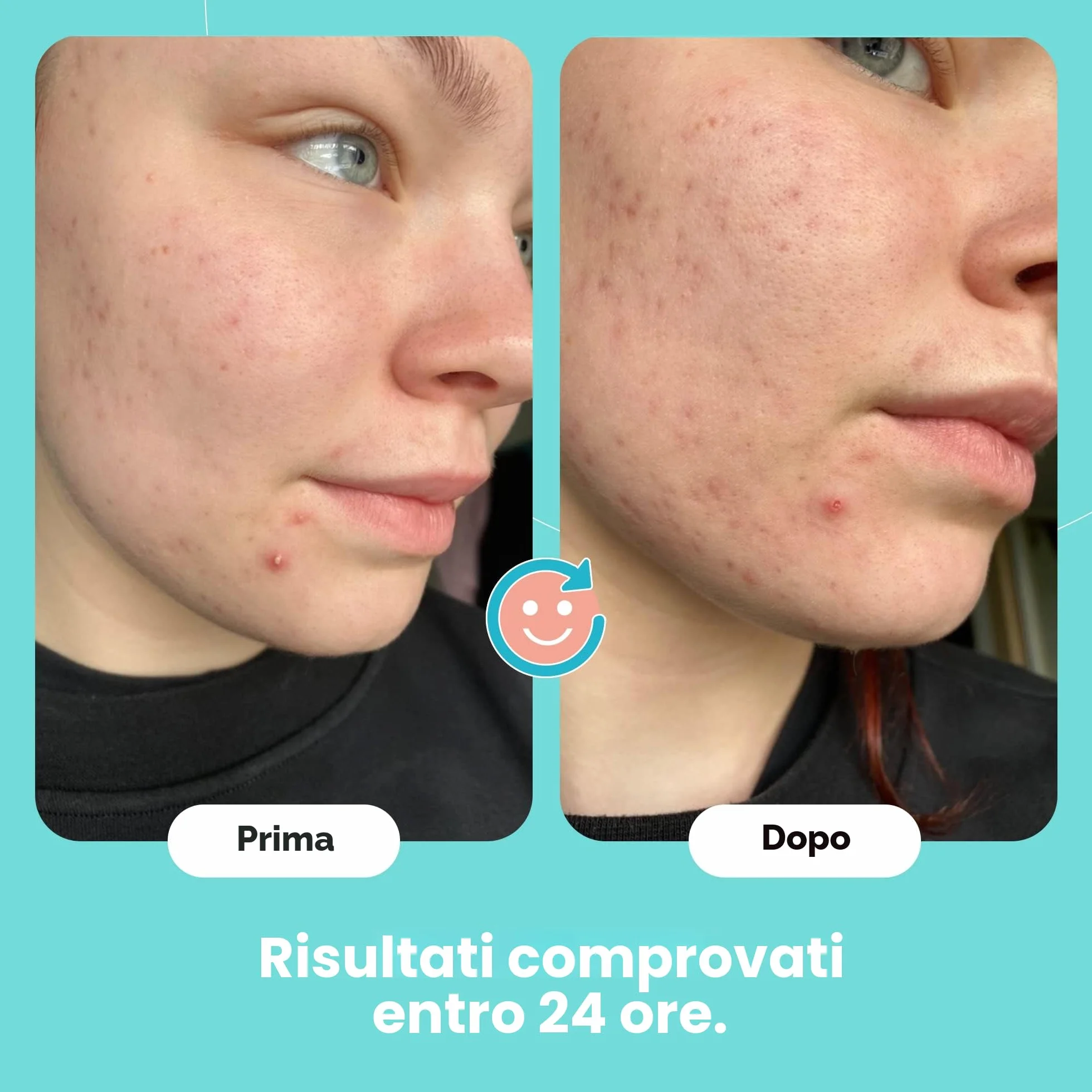 SKIN CHOICE Patch Brufoli – Breakout Pimple Patch Classic – Idrocolloidali Invisibili Cerotti Brufoli Viso, Vegano, Non Testato Sugli Animali, Cura Della Pelle Coreana (75 Cerotti)