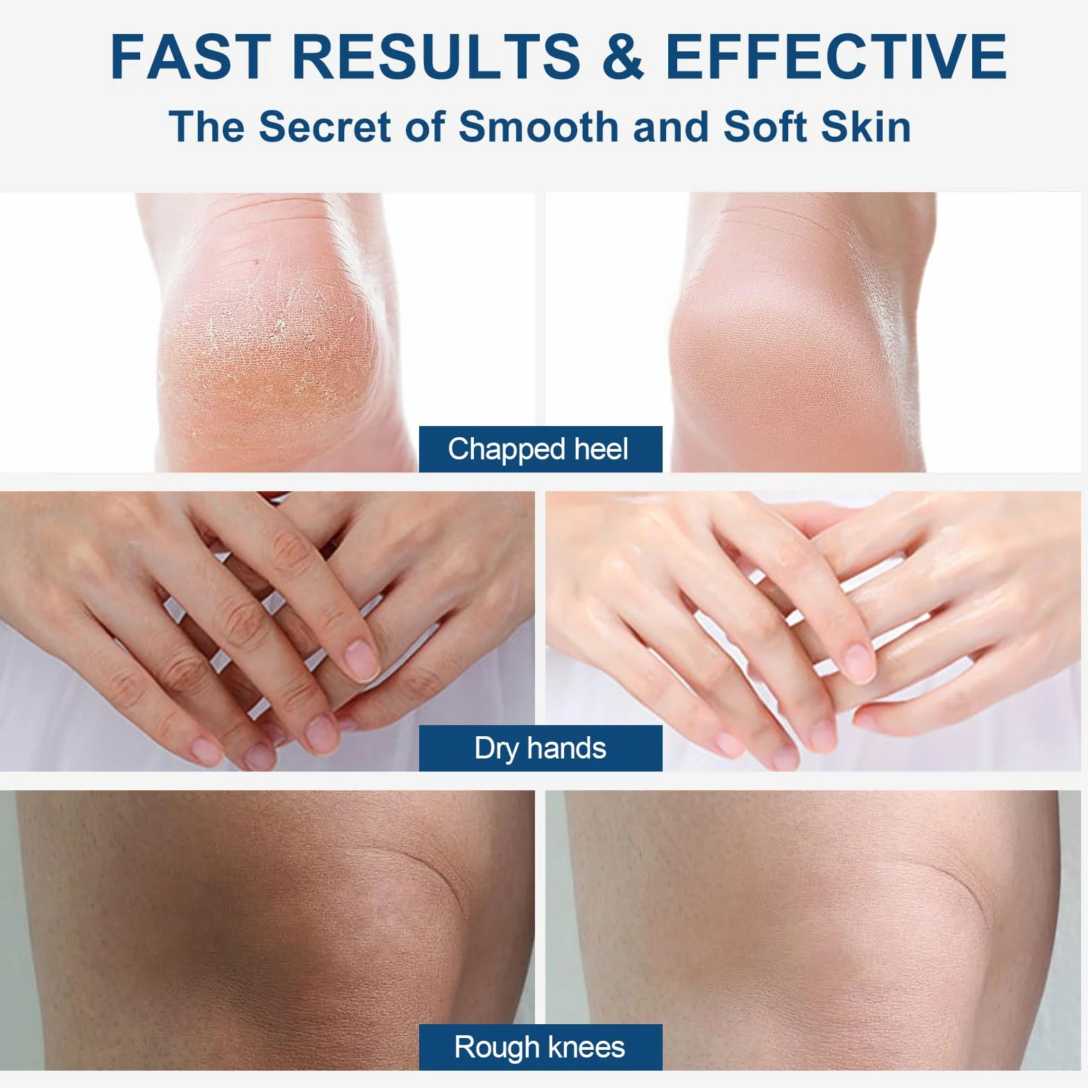 Crema Piedi Urea 40% 150g Trattamento Per Talloni Screpolati Ammorbidimento Dei Calli