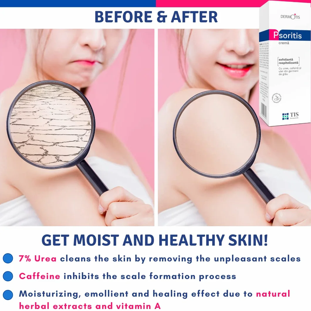 TIS Crema Urea 7%, per Eczemi, Pelle sogeto a Psoriasi, Cheratosi - Guarigione Delle Ferite - Pelle Secca, Screpolata e Ruvida - Mani, Piedi, Unghie, Gomiti, Ginocchia - Caffeina, Vit A