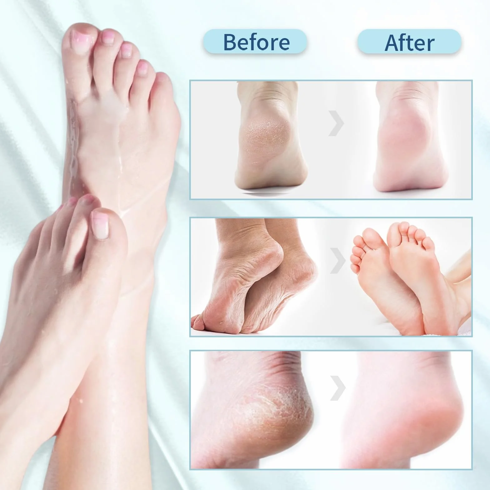 5 paia Maschera Esfoliante Piedi,Peeling Piedi,Idratante,Secchi e Screpolati,con Strumenti Pedicure per Uomo e Donna