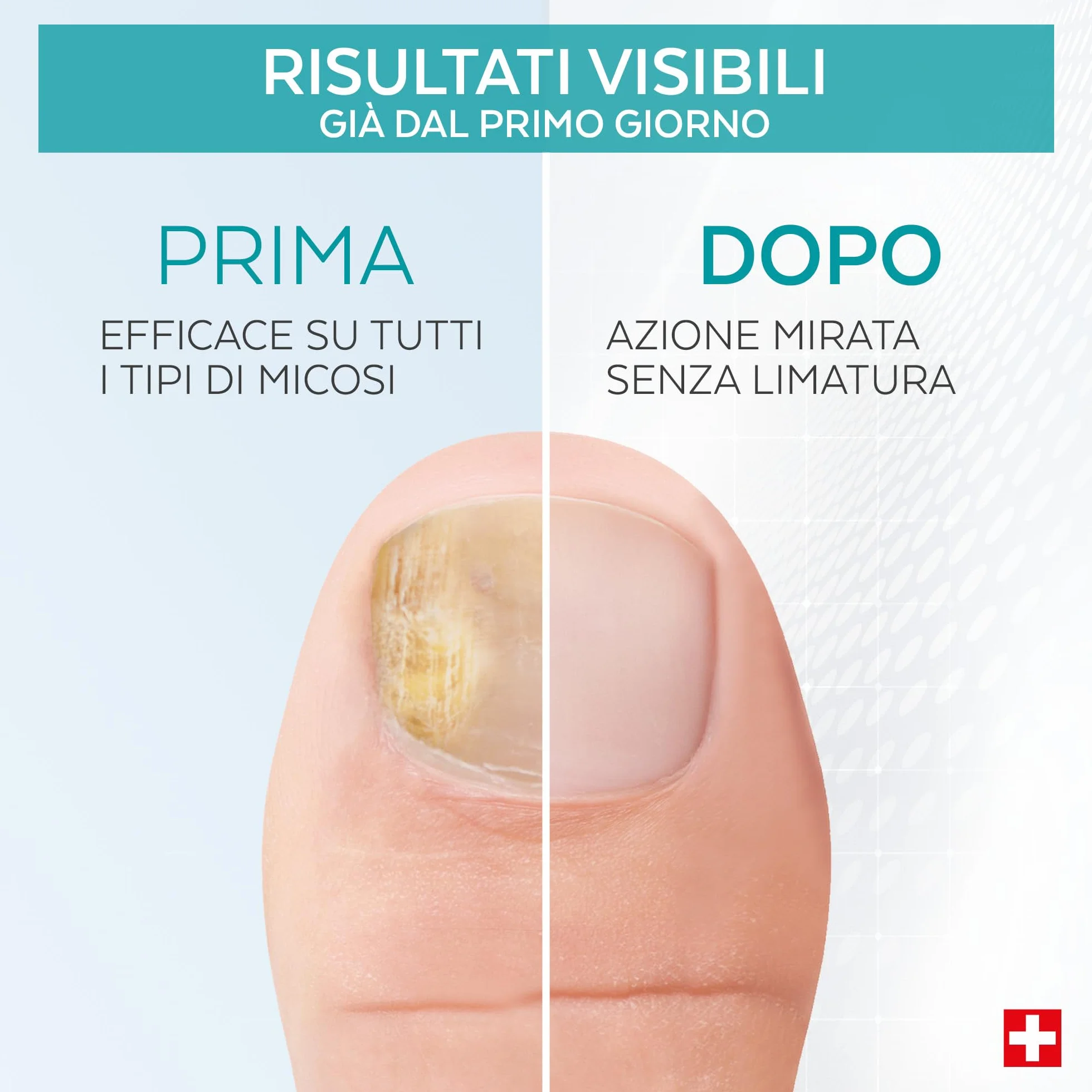 Poderm Penna Siero per il Trattamento della Micosi delle Unghie – Sviluppata da un Podologo – Prodotta in Svizzera – Penna Supplend per la Cura delle Unghie di Mani e Piedi – Trattamento per Infezioni