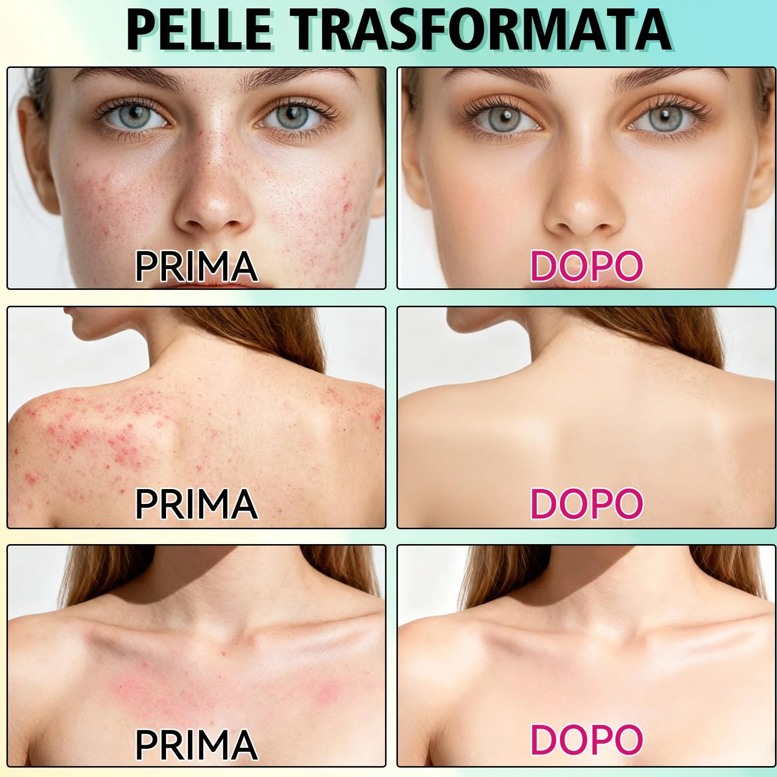 Crema Brufoli Viso, Crema Acne Potentissima, Cura per Brufoli e Imperfezioni, Riduce Subito Acne e Brufoli, Punti Neri e Rossori, Adatta a Tutti i Tipi di Pelle e Età,per la Pelle di Viso e Corpo