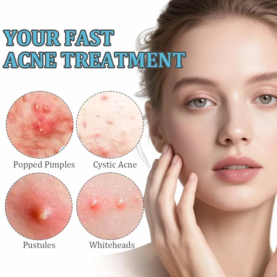 Strisce per punti neri e impurità,720 cerotti per l'acne, adesivi per il trattamento dell'acne per feste di trucco