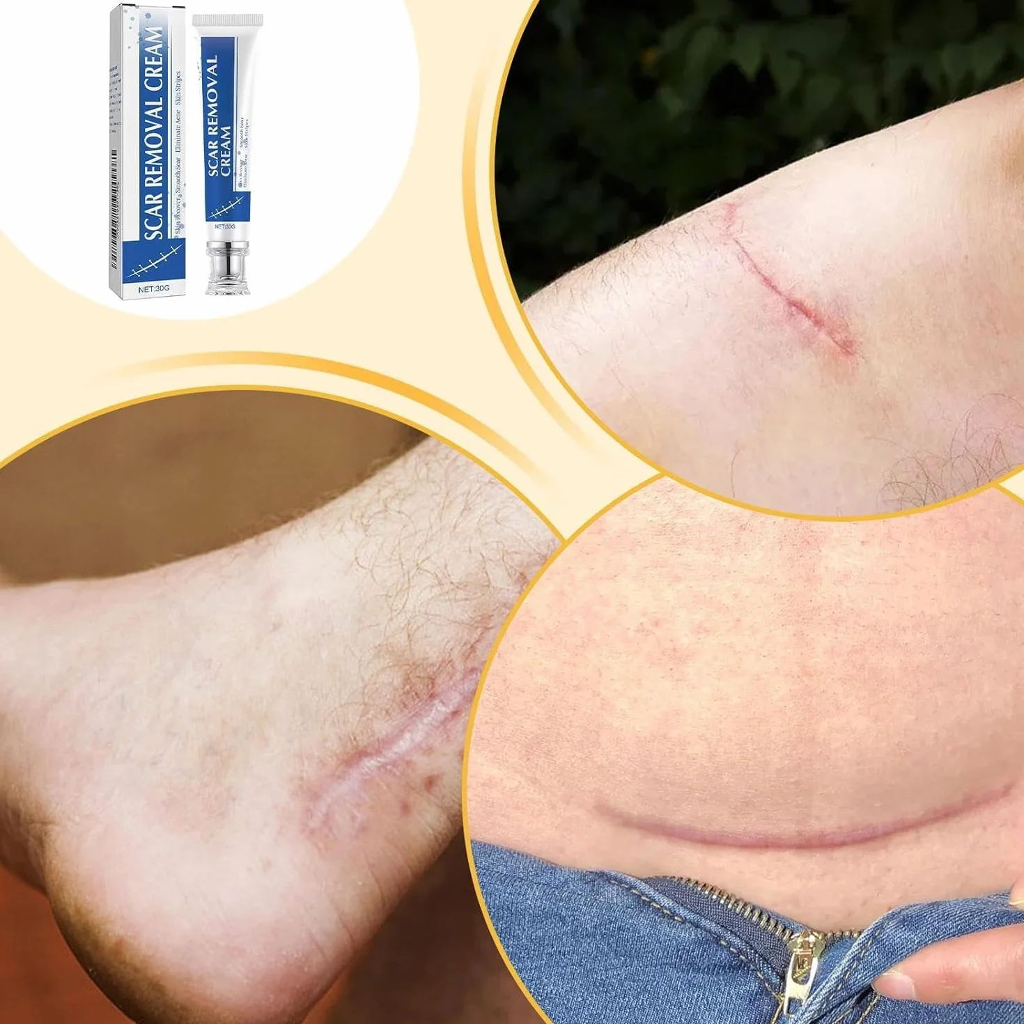 Crema per cicatrici, unguento per la rimozione delle smagliature, ammorbidisce la pelle ruvida, schiarisce ustioni e cicatrici post-operatorie, per la routine quotidiana di ginocchia, ustioni
