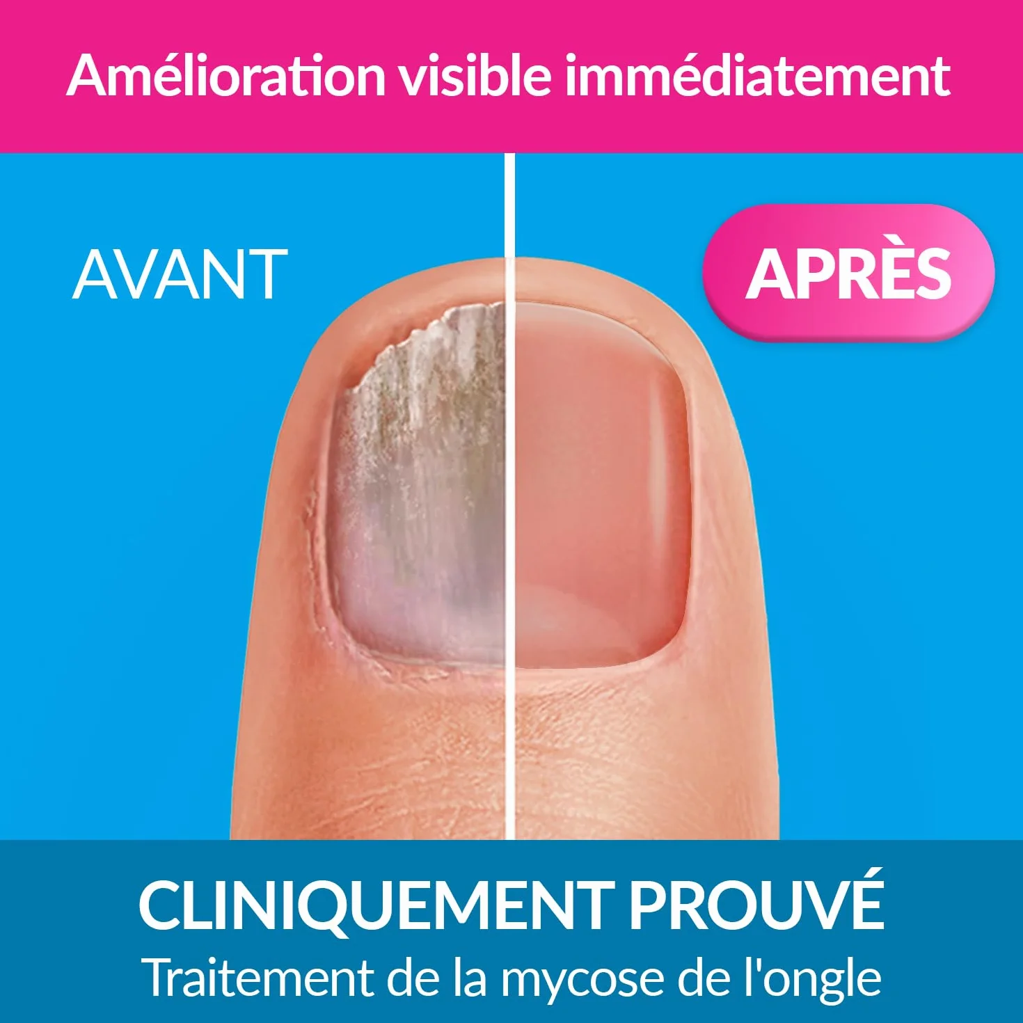 EXCILOR - Forte Color - Trattamento della micosi dell'unghia - Tratta e copre - Trattamento 30 ml + Smalto cosmetico per unghie da 8 ml - Clinicamente provato* - Nude