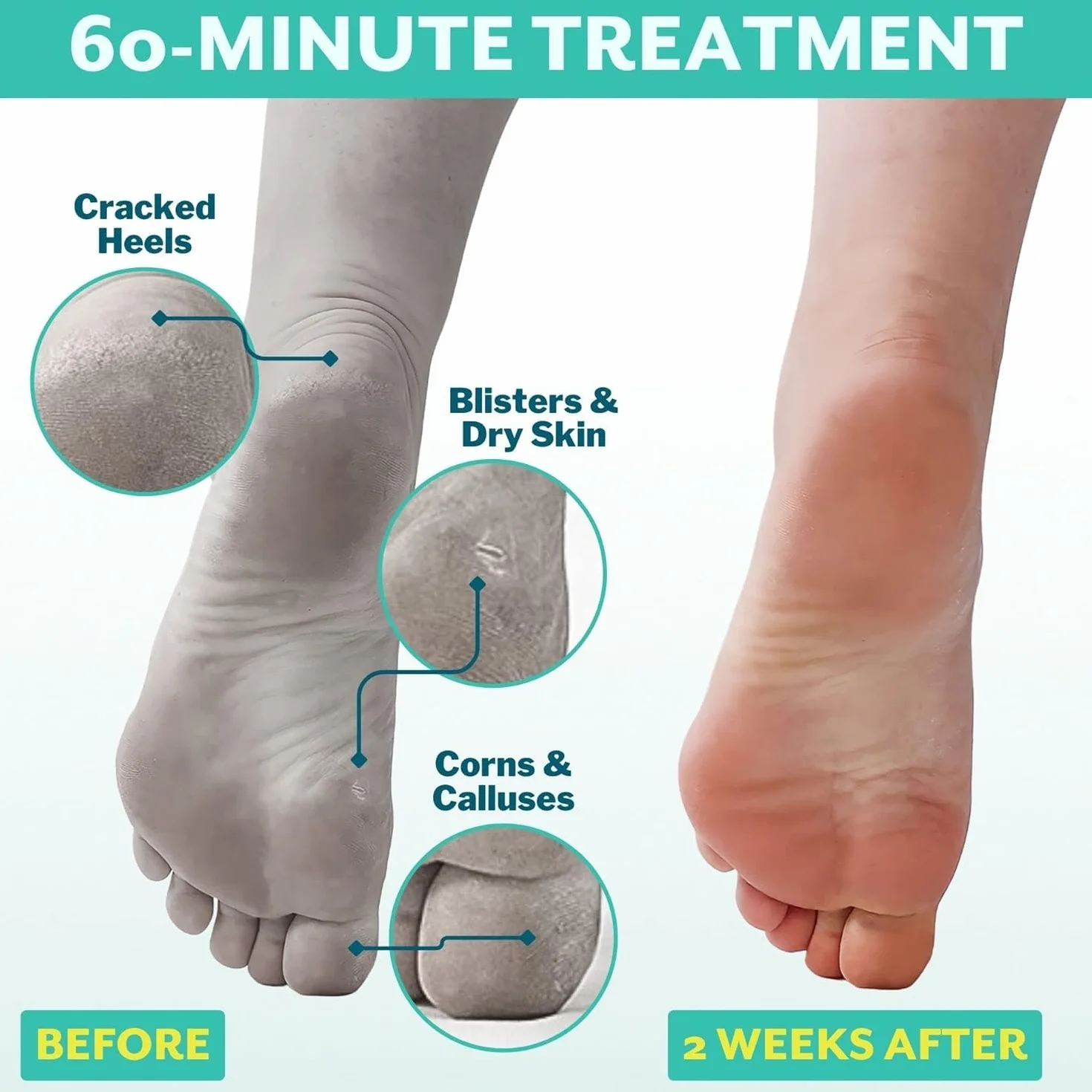 patchology POSHPEEL Trattamento per pedicure, confezione da 1 pezzo