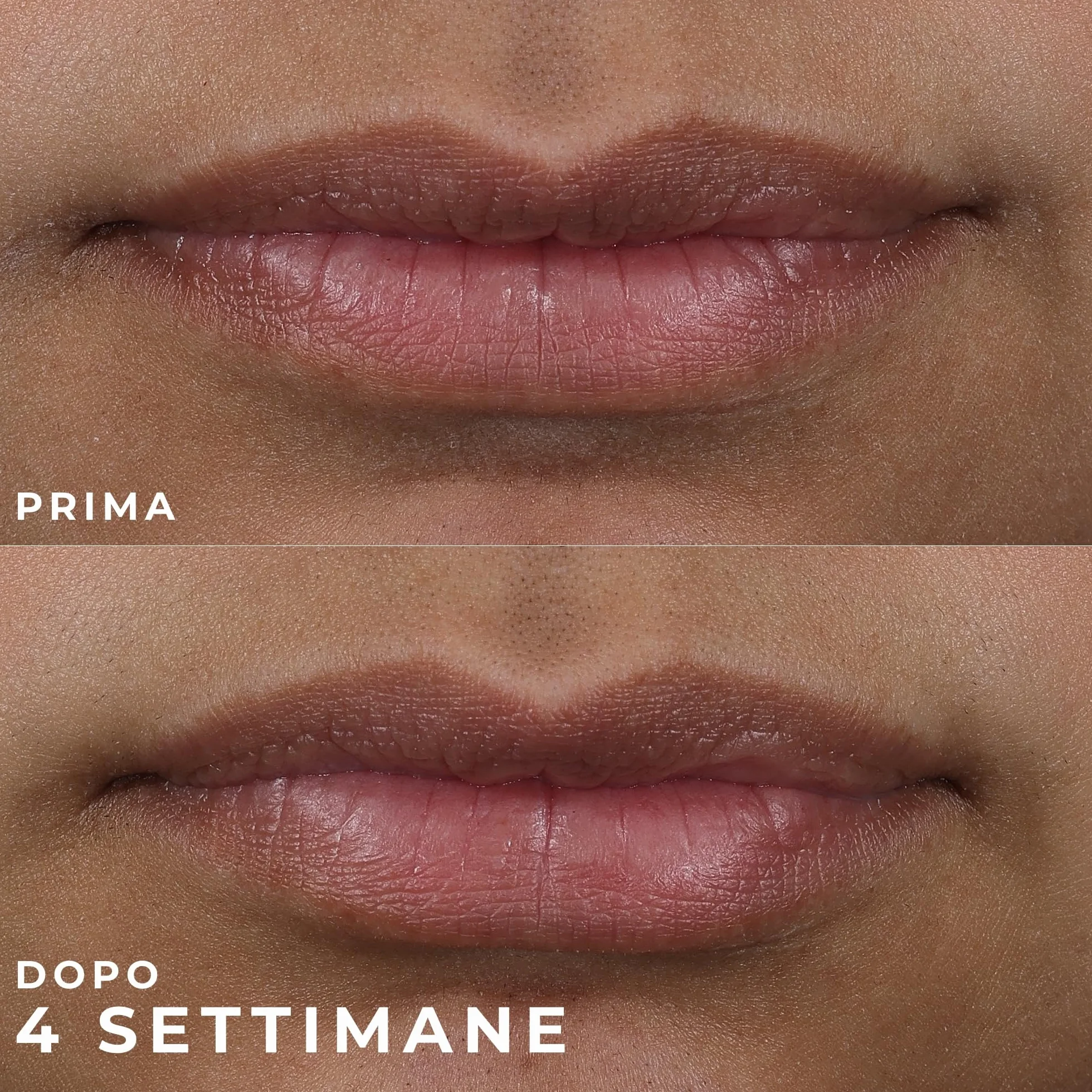 RoC Derm Correxion Volumizzante Labbra Balsamo Rimpolpante con Acido Ialuronico e Peptidi di Collagene 10 ml