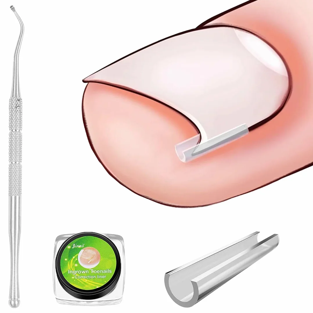 50 pezzi Set correttore per unghie incarnite, Strisce raddrizzanti per unghie incarnite senza dolore con sollevatore per unghie, Kit di strumenti per unghie incarnite facili da usare