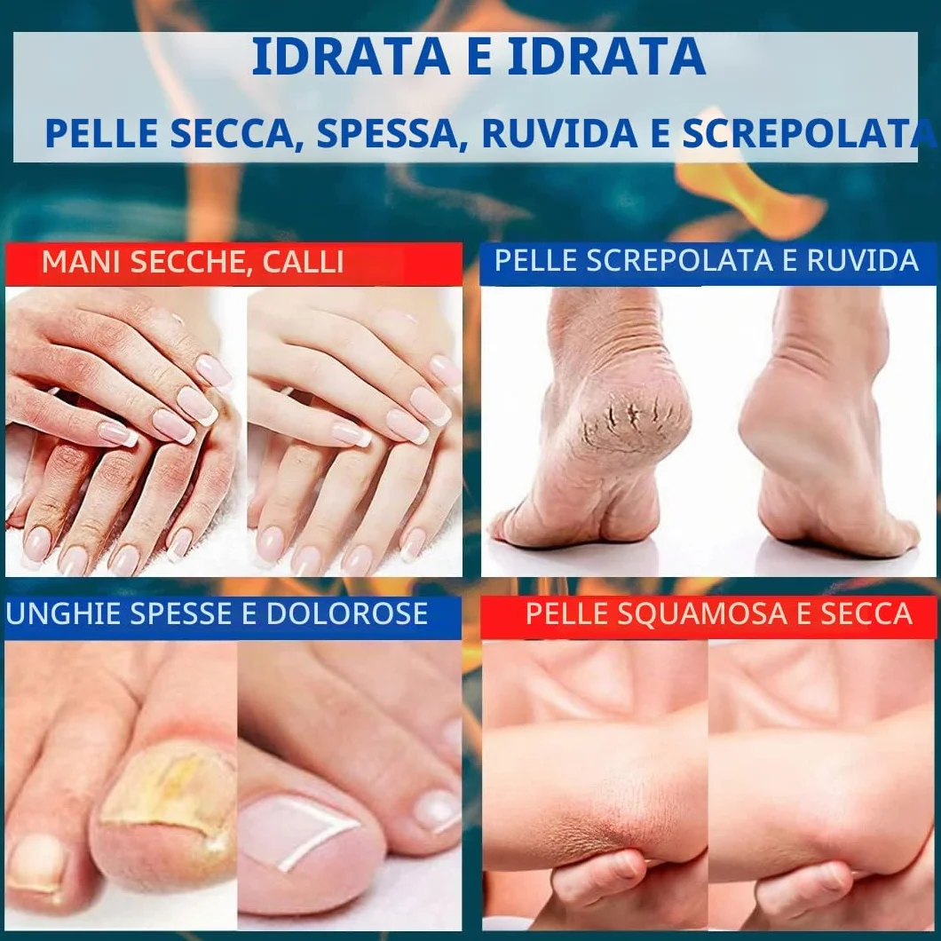 TIS Crema con urea 30% per cicatrici eczemi psoriasi con acido lattico e alfaidrossiacidi
