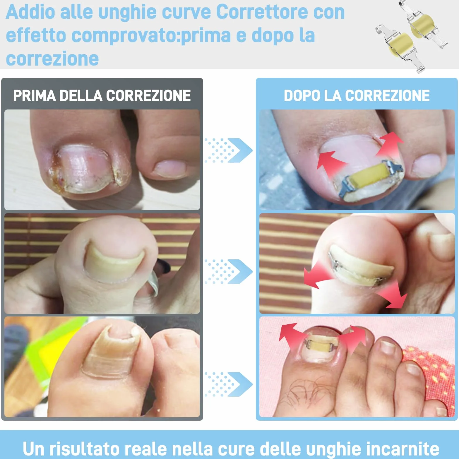 InhwRior Correttore unghie incarnite 19mm-21mm impermeabile doccia