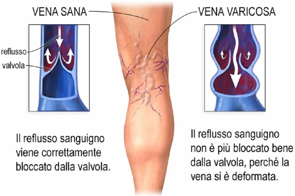 CREMA CONTRO LE VENE VARICOSE PRIMO CLASSIFICATO 2019-2021 VARICASTAN VIVANATURA 100% NATURALE SENZA PARABENI LAVORATA A FREDDO IMBALLO ITALIANO L'ORIGINALE 100%