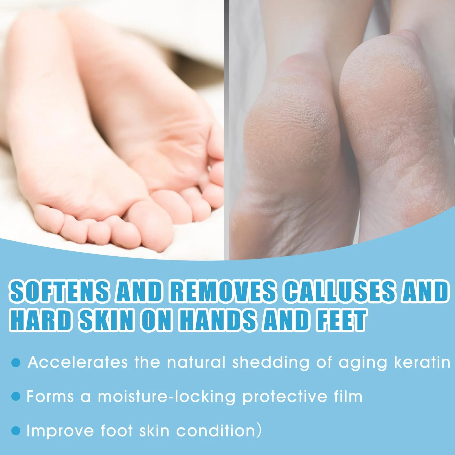 Cheratolitico Piedi, Callus Remover, Esfoliante Piedi, Lima per Piedi in Nano-Vetro, Ammorbidisce la Pelle dei Piedi, Idrata in Profondità, Allevia Secchezza e Screpolature, 250 ml