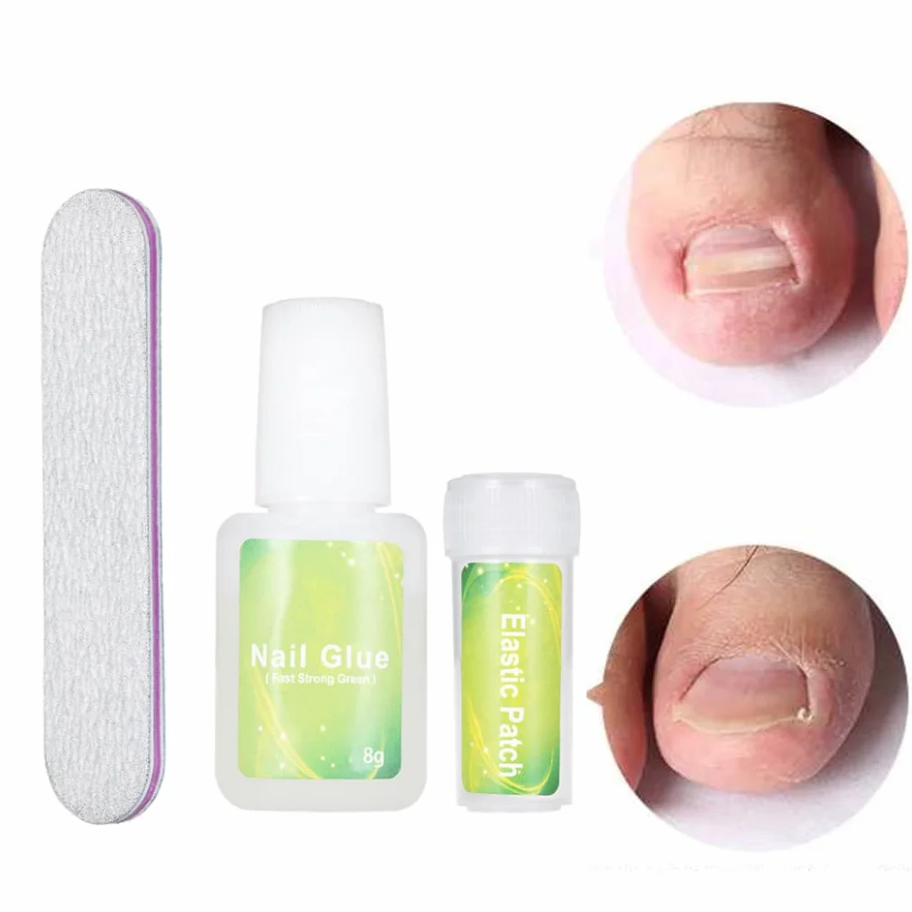 Kit di correzione della patch di unghie dei piedi incarniti elastico patch per chiodi con glu -correzione della file unghie