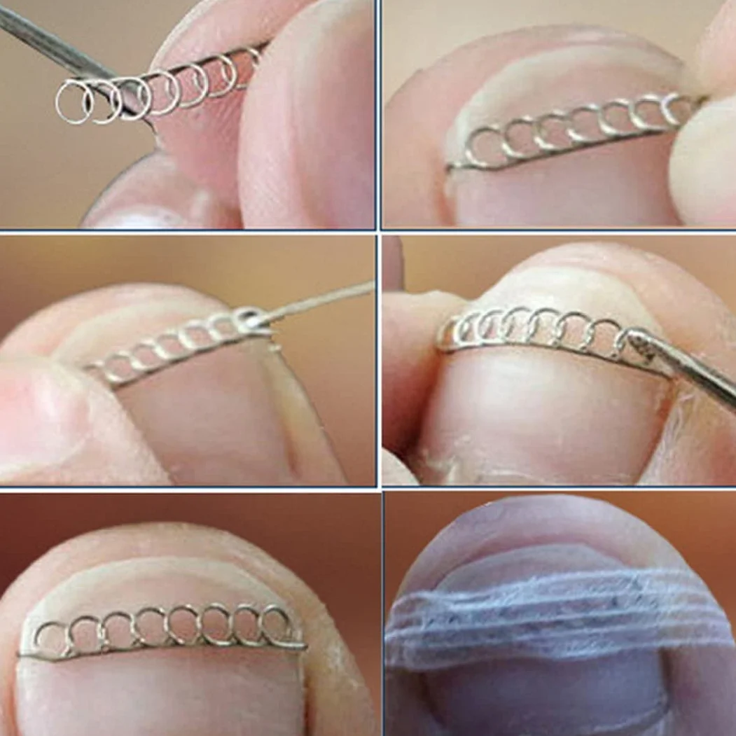 Filo correttore di punta incarnita, filo di correzione dell'unghia del piede Ingrimato di pedicure utensile inossidabile Recupero di unghie in acciaio inossidabile correttore 12pcs 12pcs