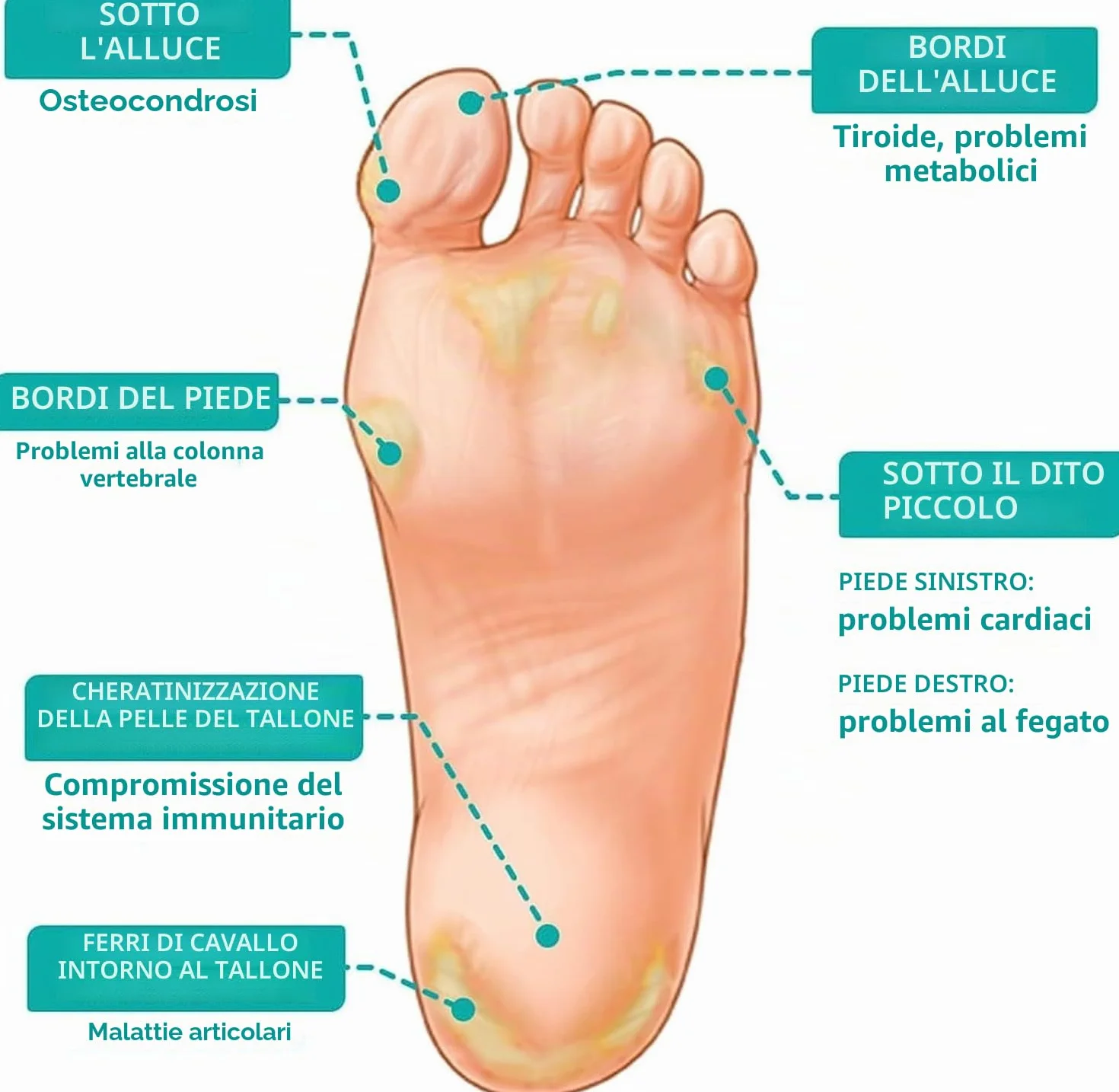 Spray extra forte per rimuovere i calli: spray rimuovi calli per piedi e tallone, olio spray per pelle morta